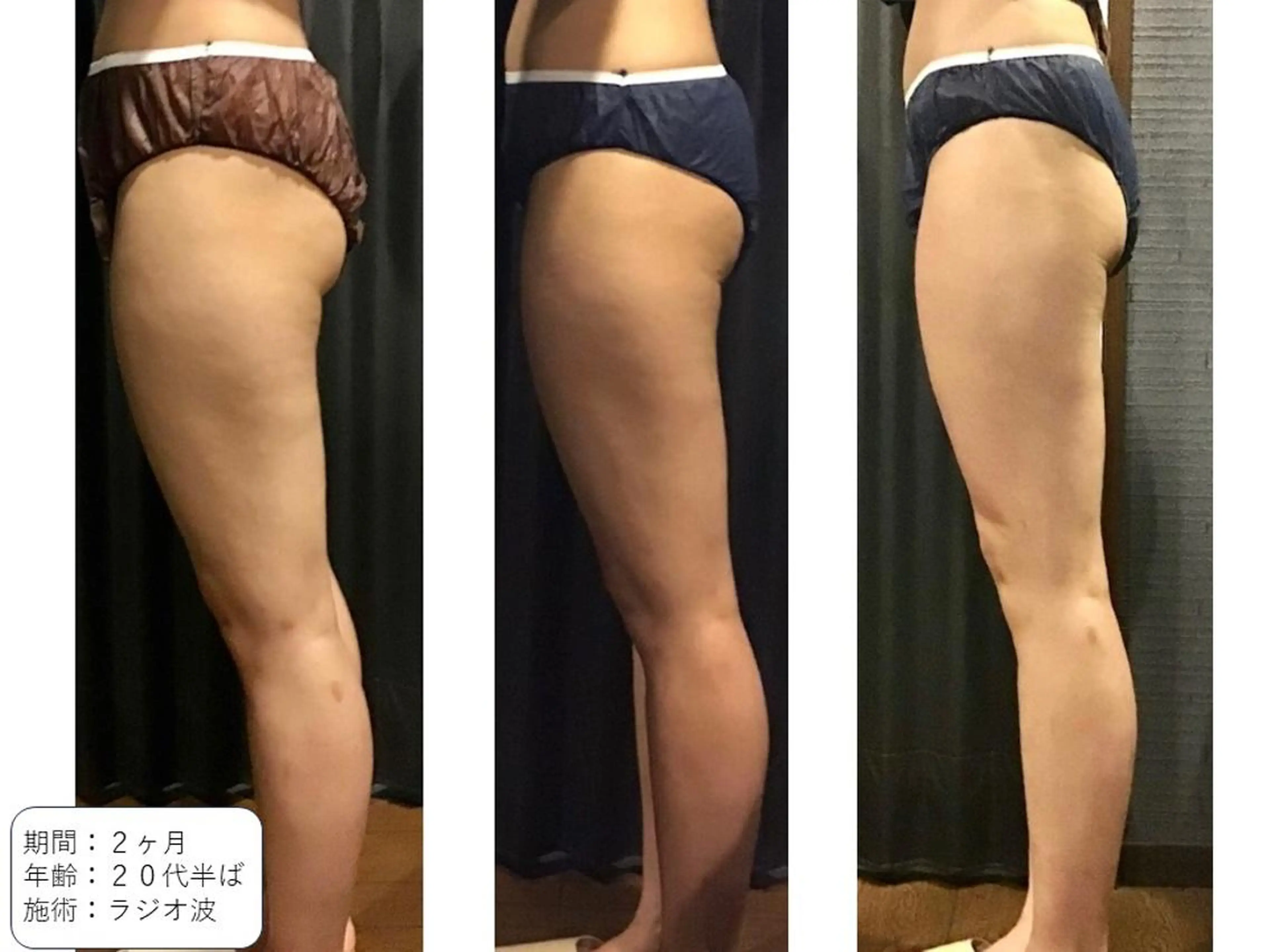 【お試し痩身60分☆1部位集中】ラジオ波リンパ60分美脚orくびれウエスト・お腹周り60分の写真