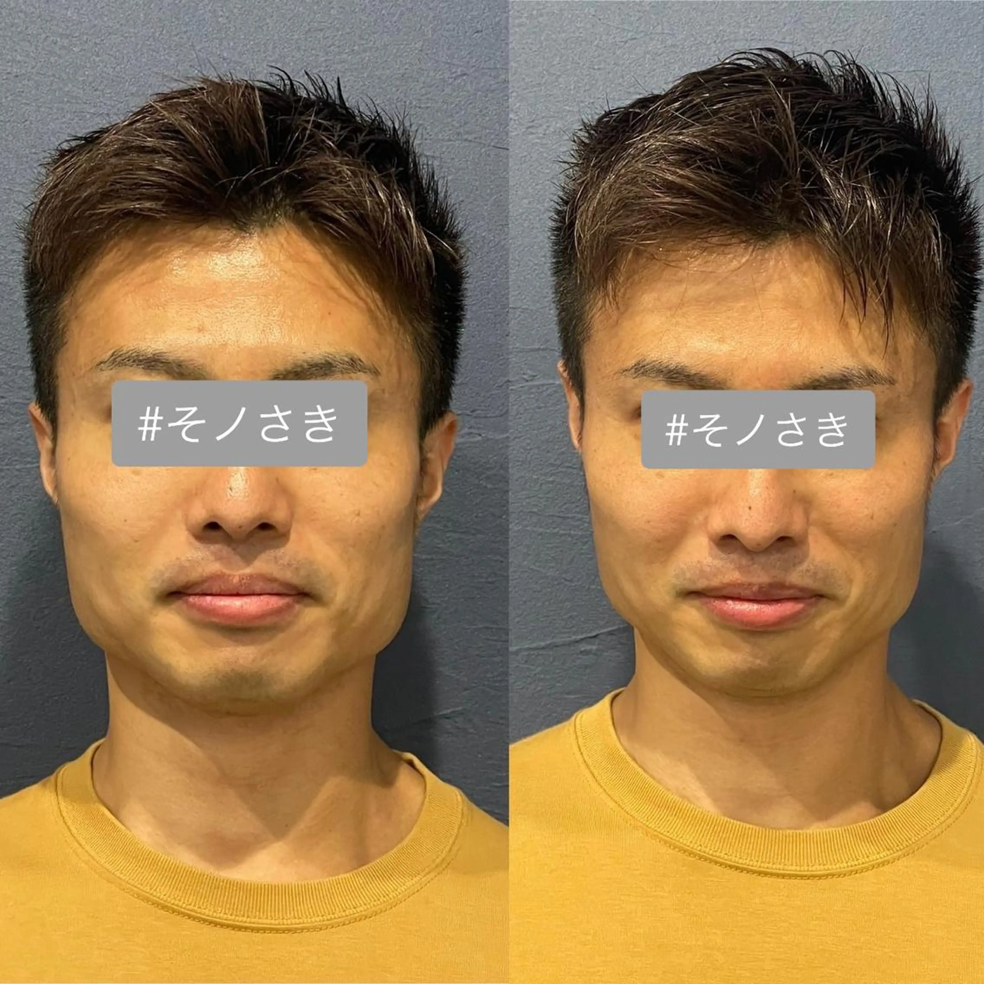 ミニモ限定メニュー✨美容鍼🔥フェイスライン、エラ張りに特化🔥針＋矯正マッサージ💆の写真