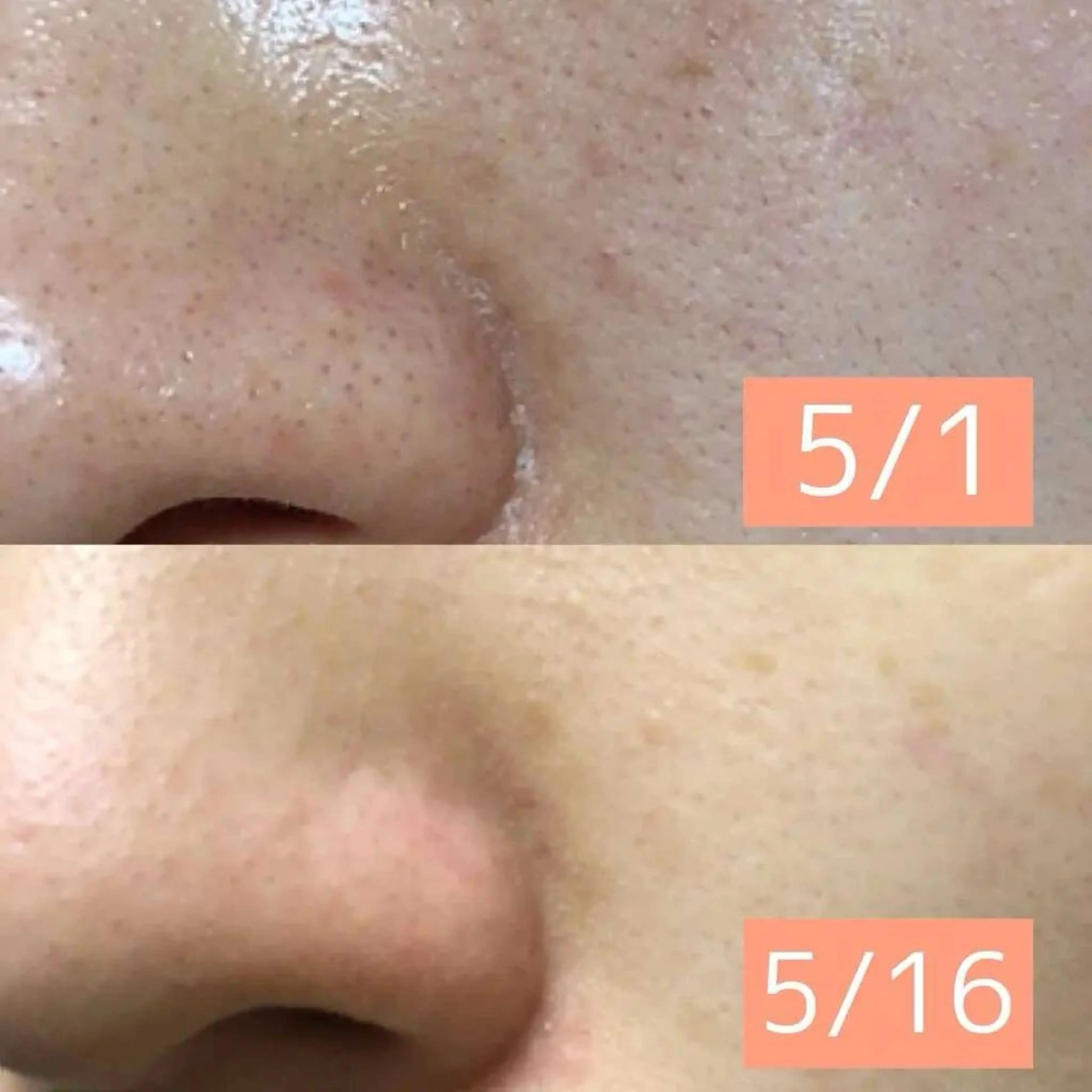 【毛穴悩み集中】黒ずみ・詰まり・開きケア✨フェイシャルの写真