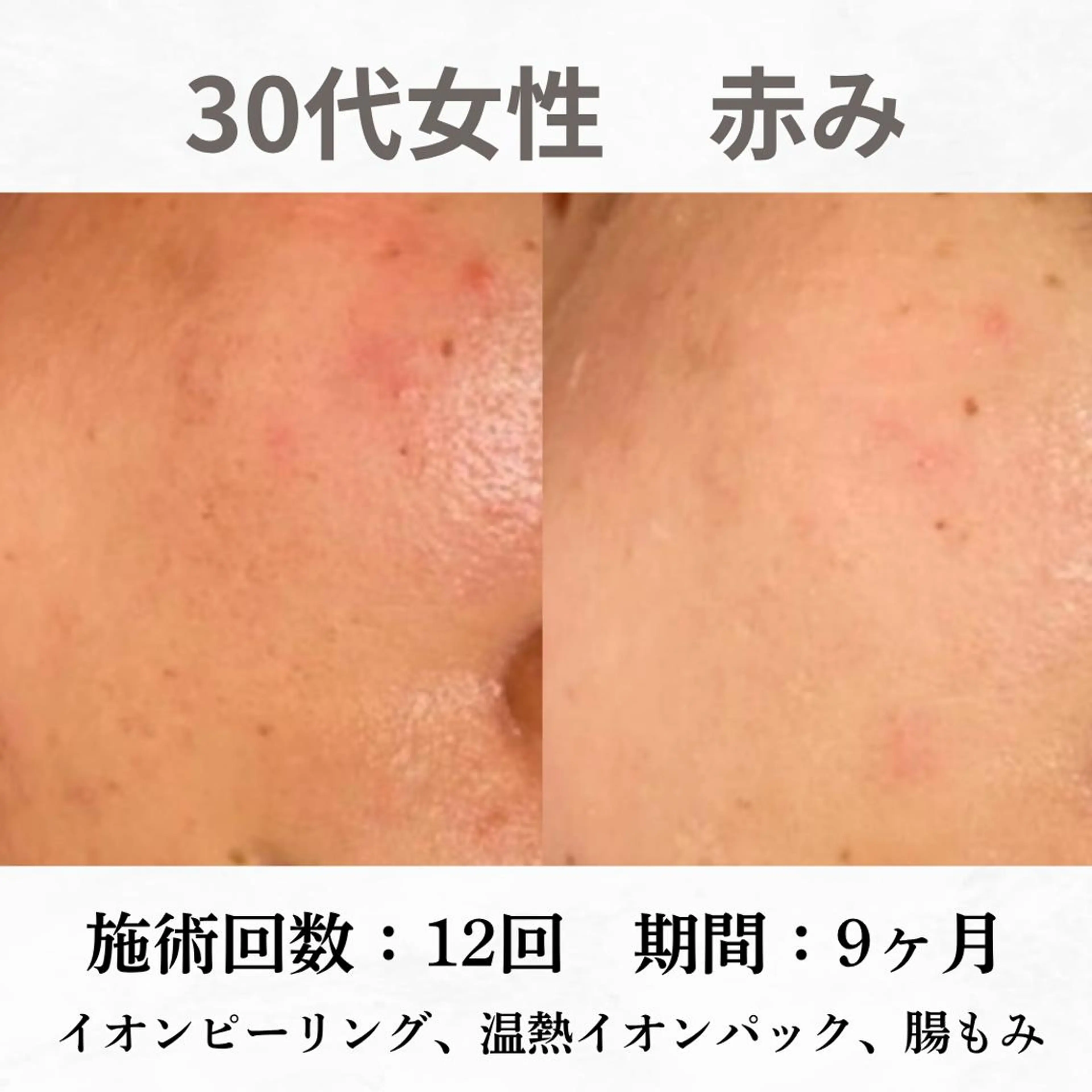 重度ニキビ専門🌷 ダウンタイムなしのエステ・リラクイメージ