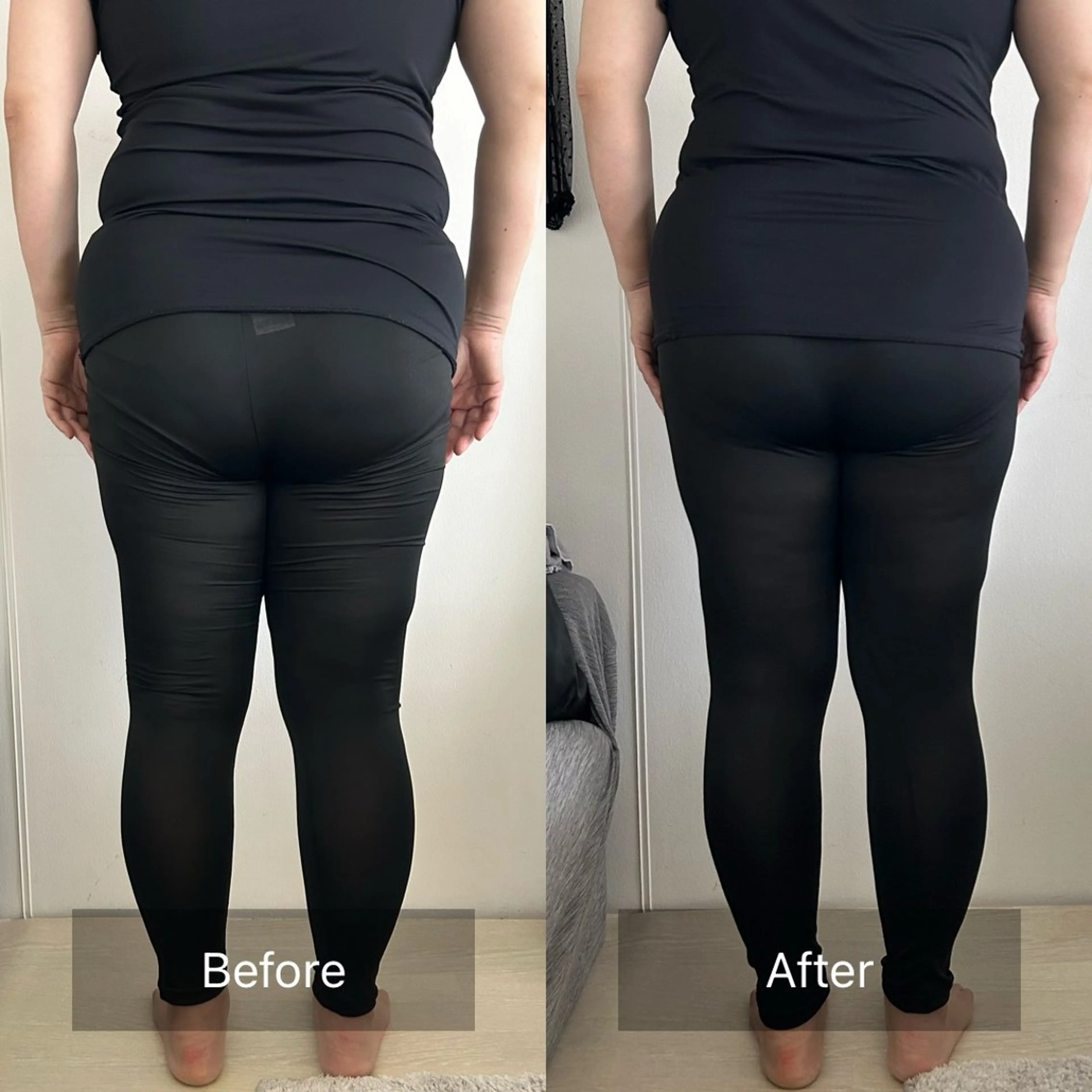 骨盤彫刻術の写真