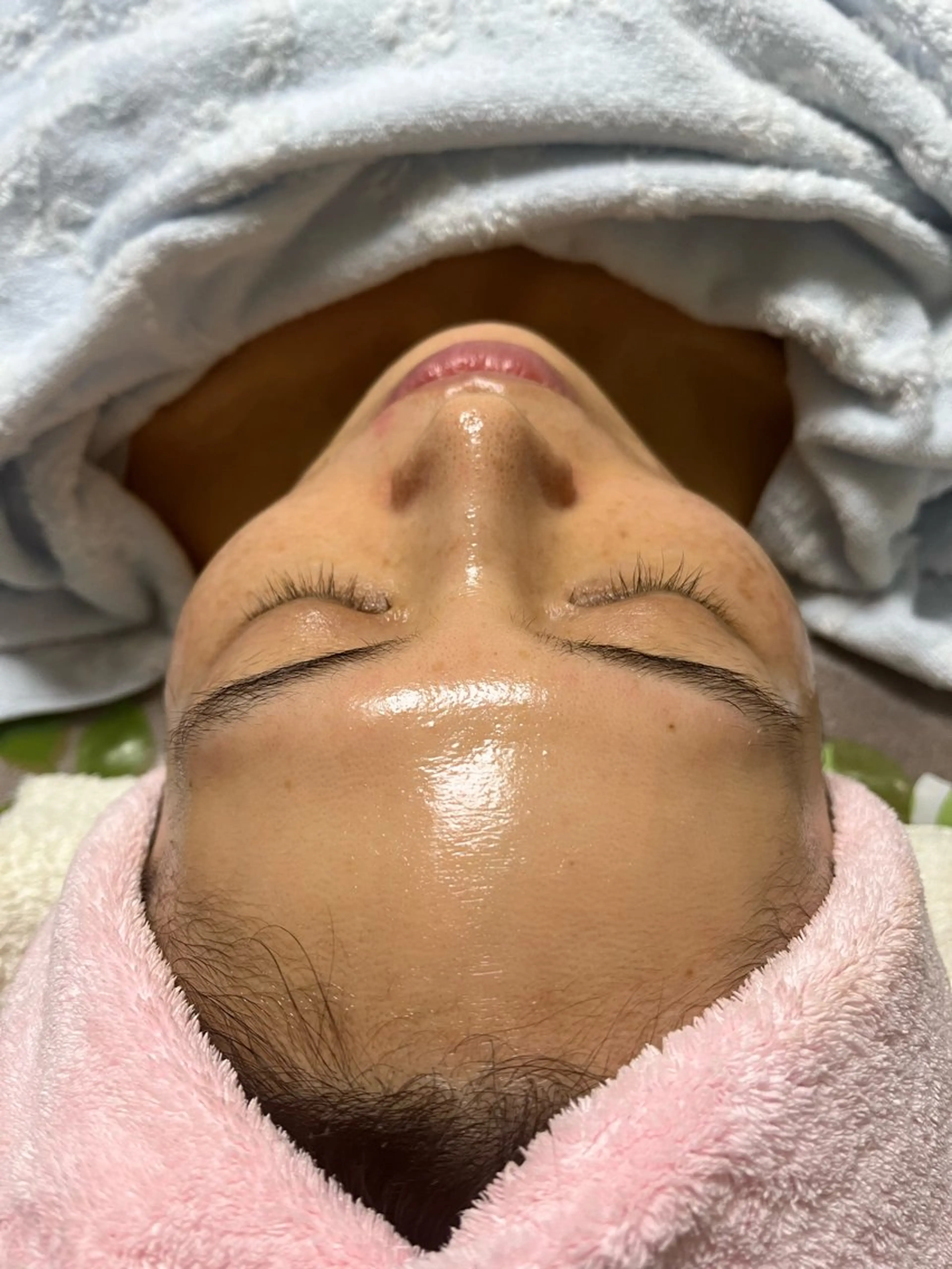 シュガーリング脱毛スキンケア　フルフェイスの写真