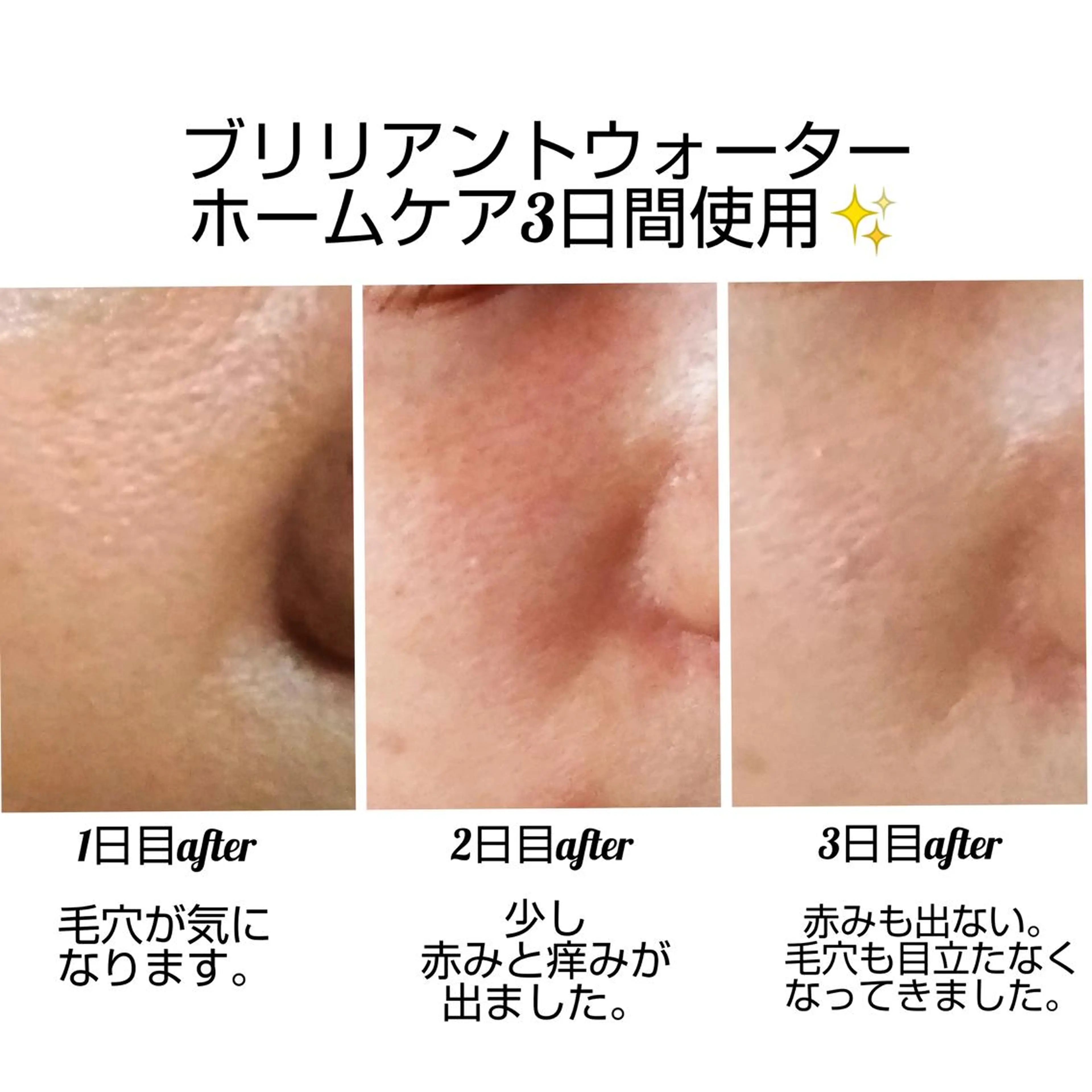 【ニキビ/肌管理】 salon varyのエステ・リラクイメージ