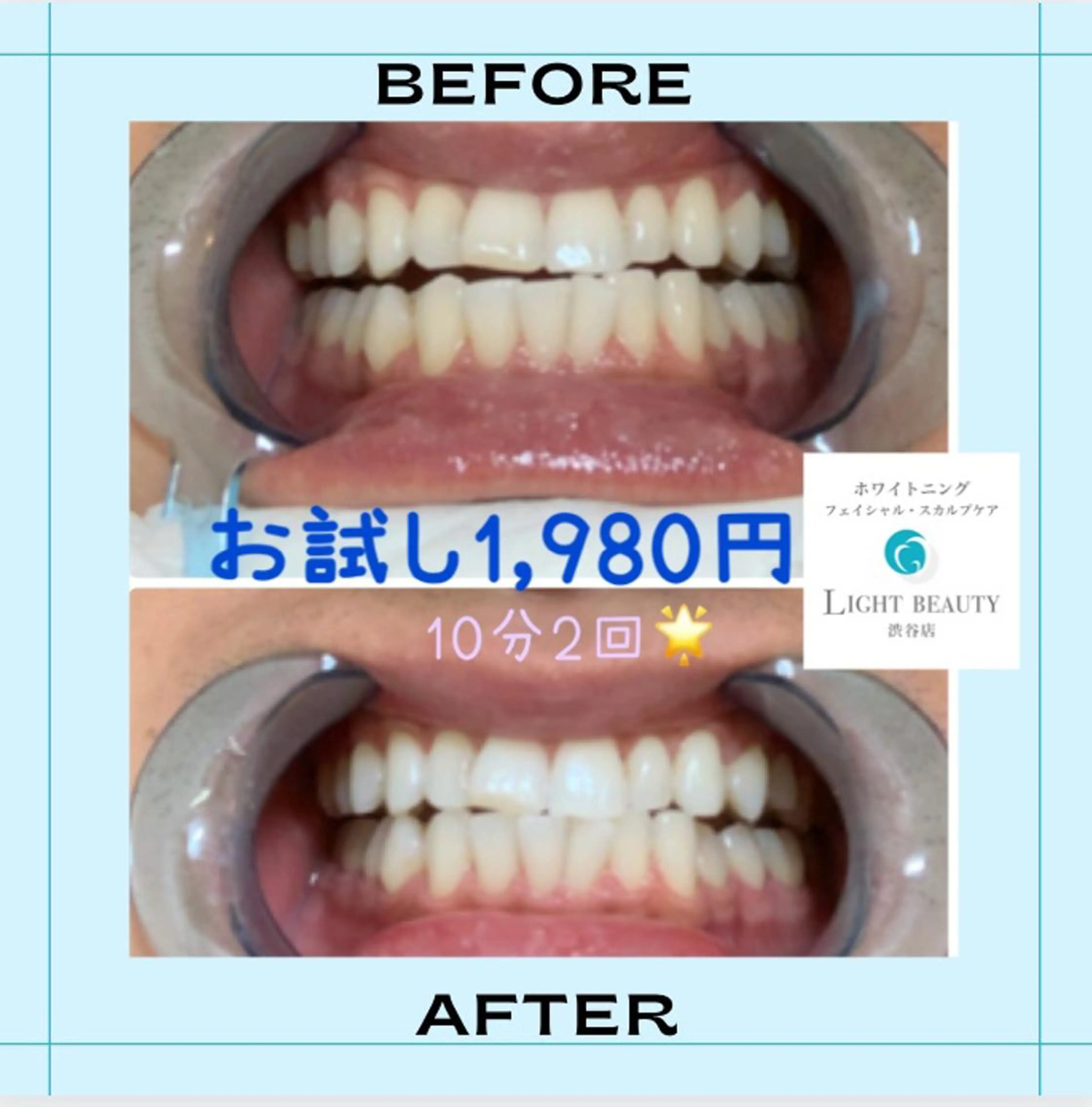 初めての方必見✨1回で効果抜群🌈🦷やって良かったの声多数✨ホワイトニングが今だけ1,980円❣️10分✖️2照射🌟の写真