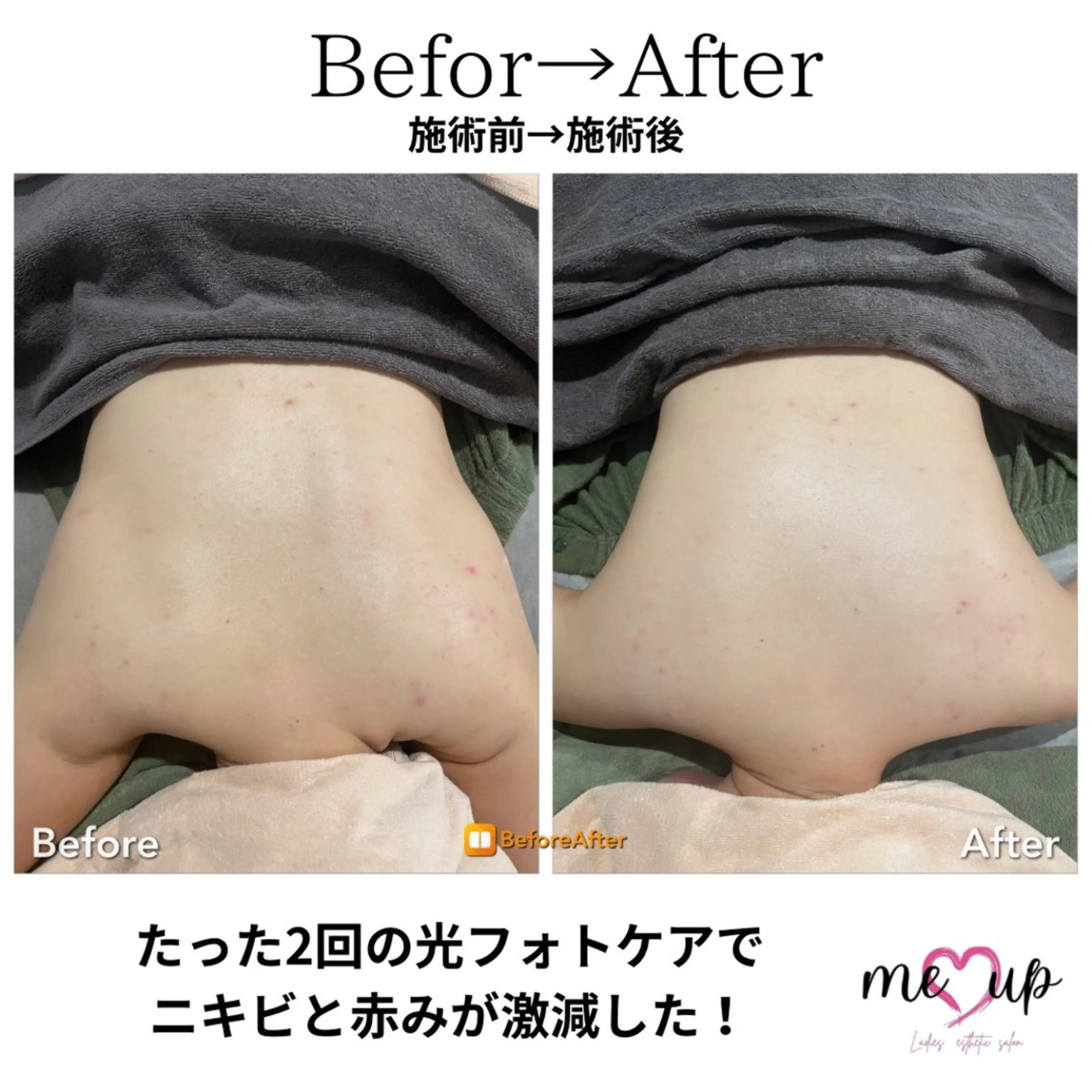 エステ Meupニキビ専門店 背中/ハーブ/肌管理のその他イメージ