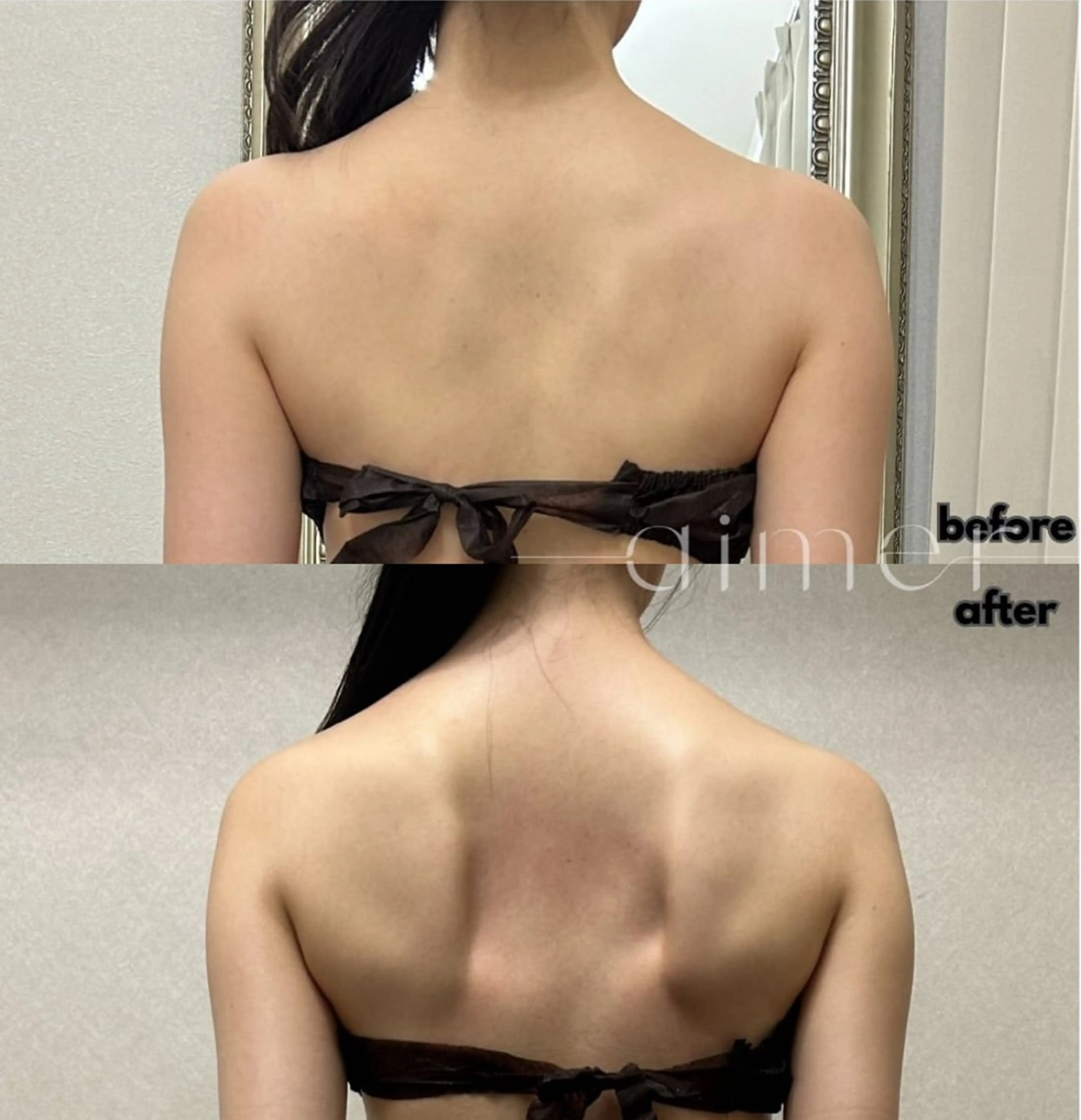 【駆け込みブライダル💍】ボディハイパーナイフ+ボディコルギ+フェイシャルハイパーナイフ+EMSの写真