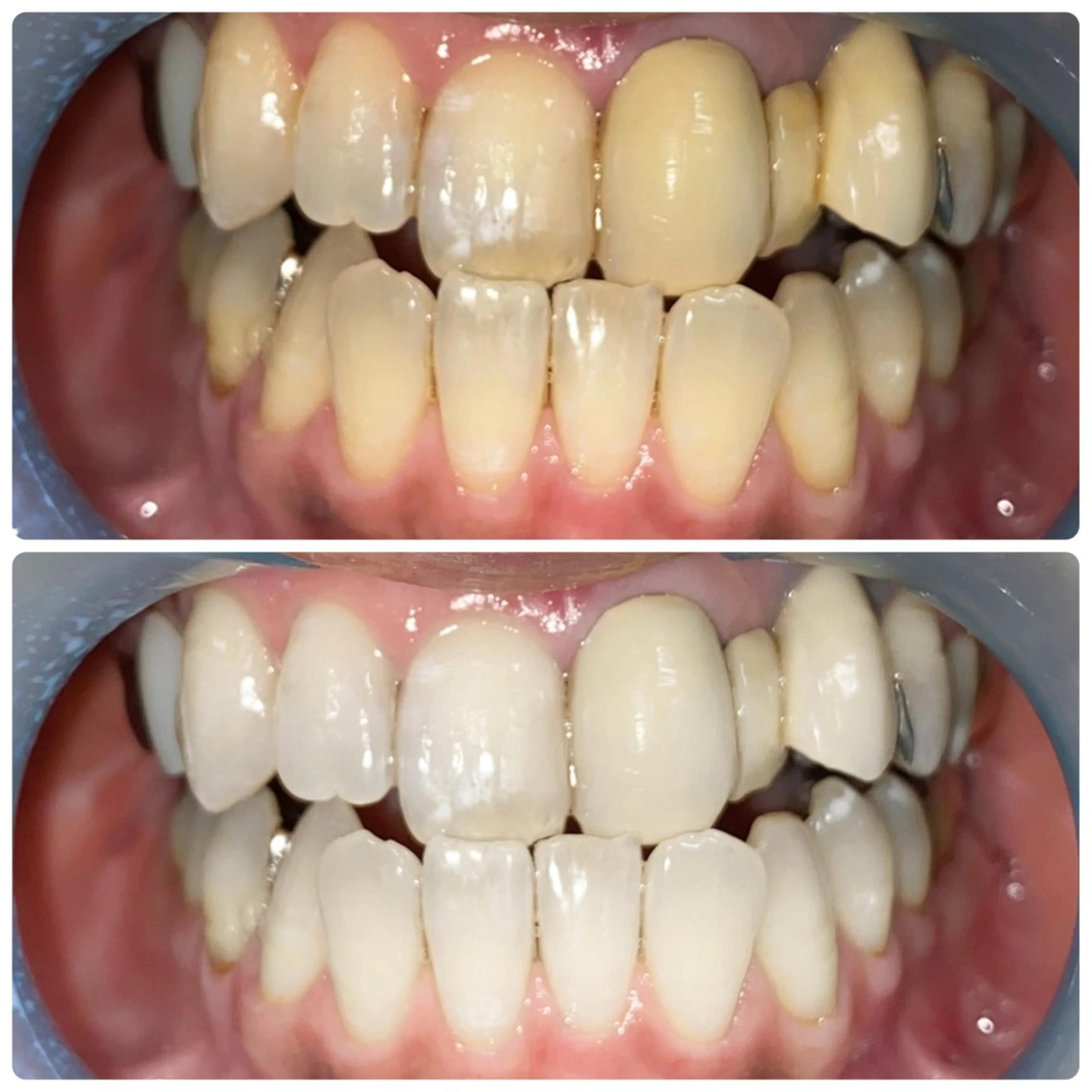 🦷セルフホワイトニング8分×2回🦷の写真