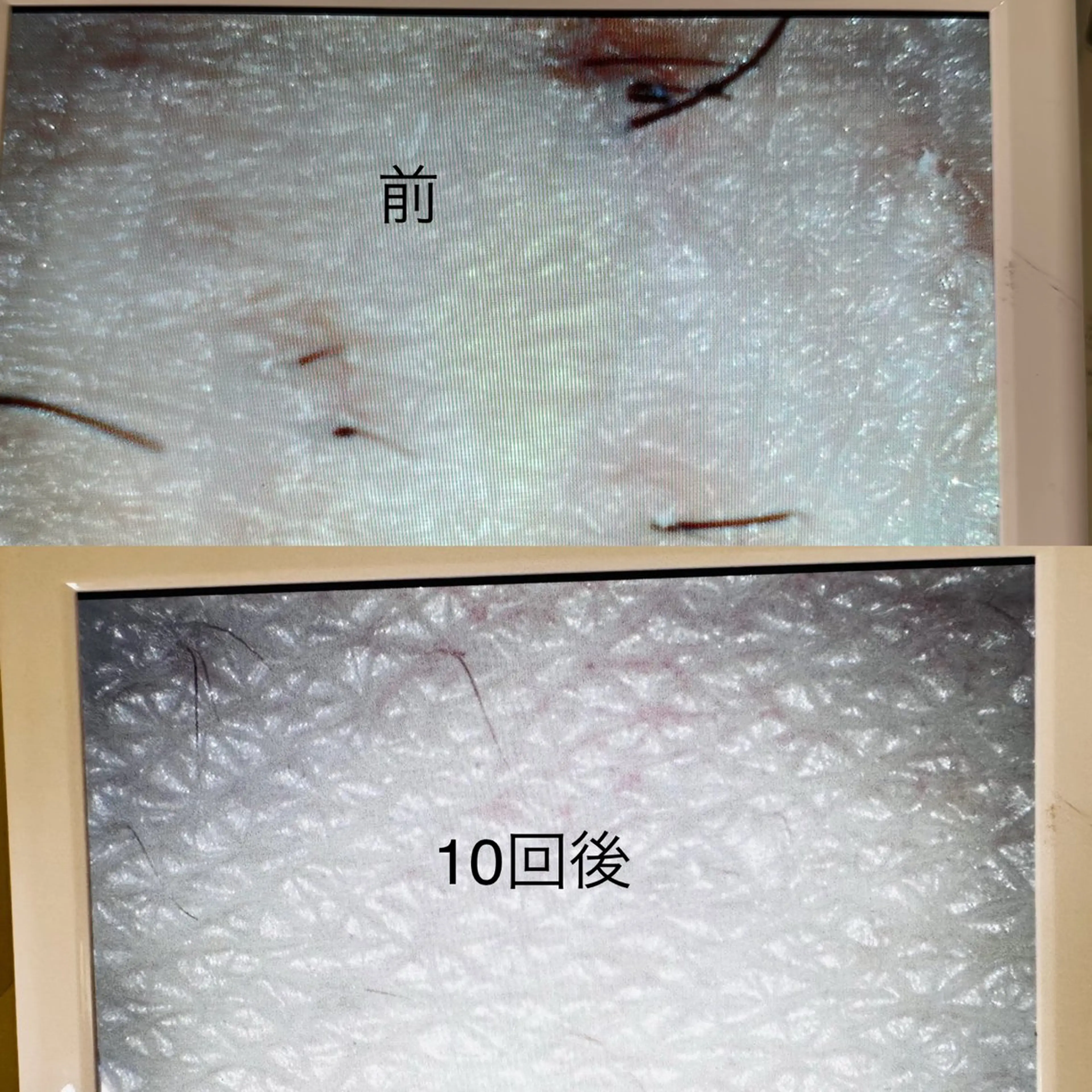 わき脱毛　8回の写真