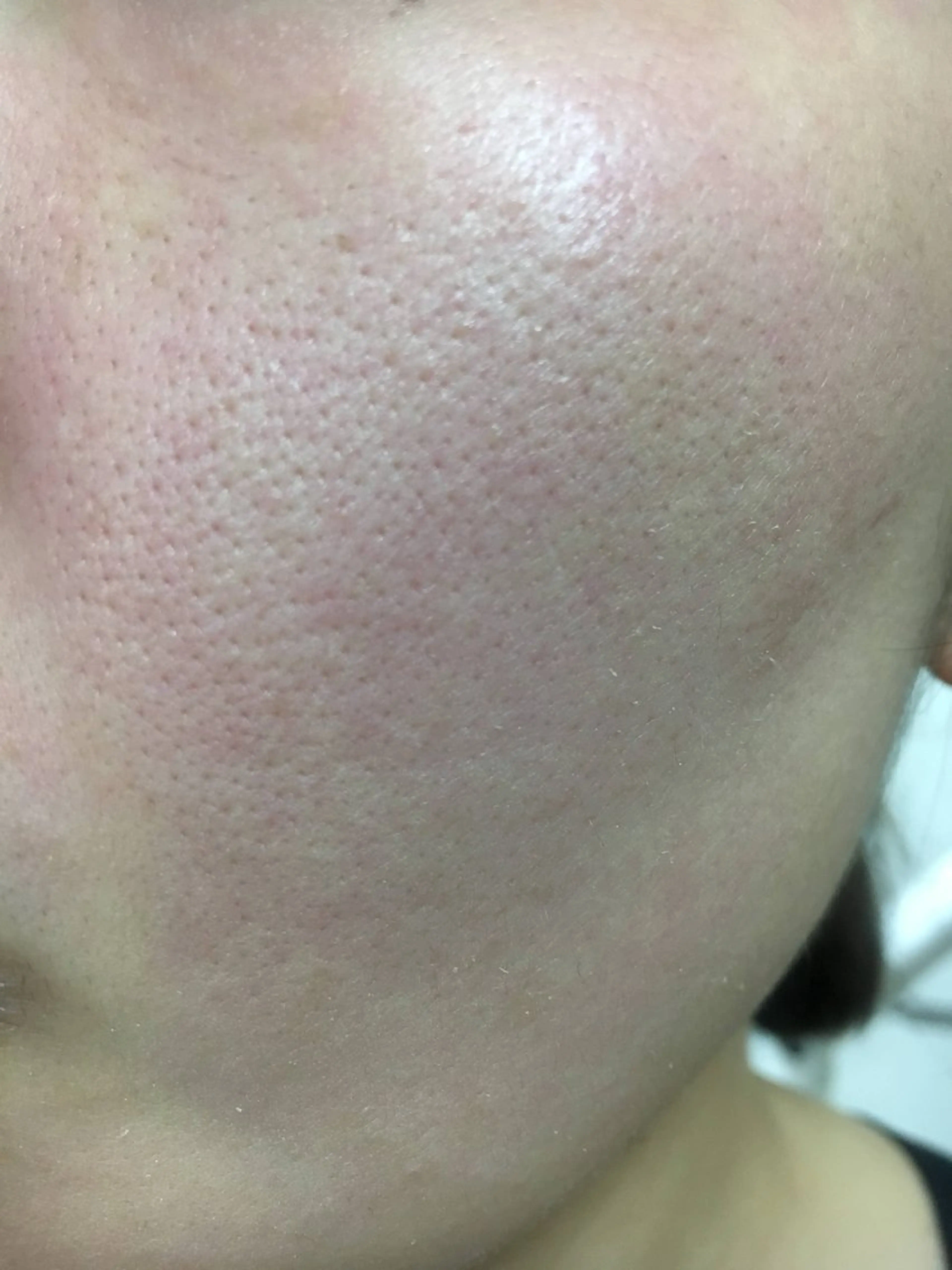 【頭皮マッサージ付】毛穴改善ピールフェイシャルの写真