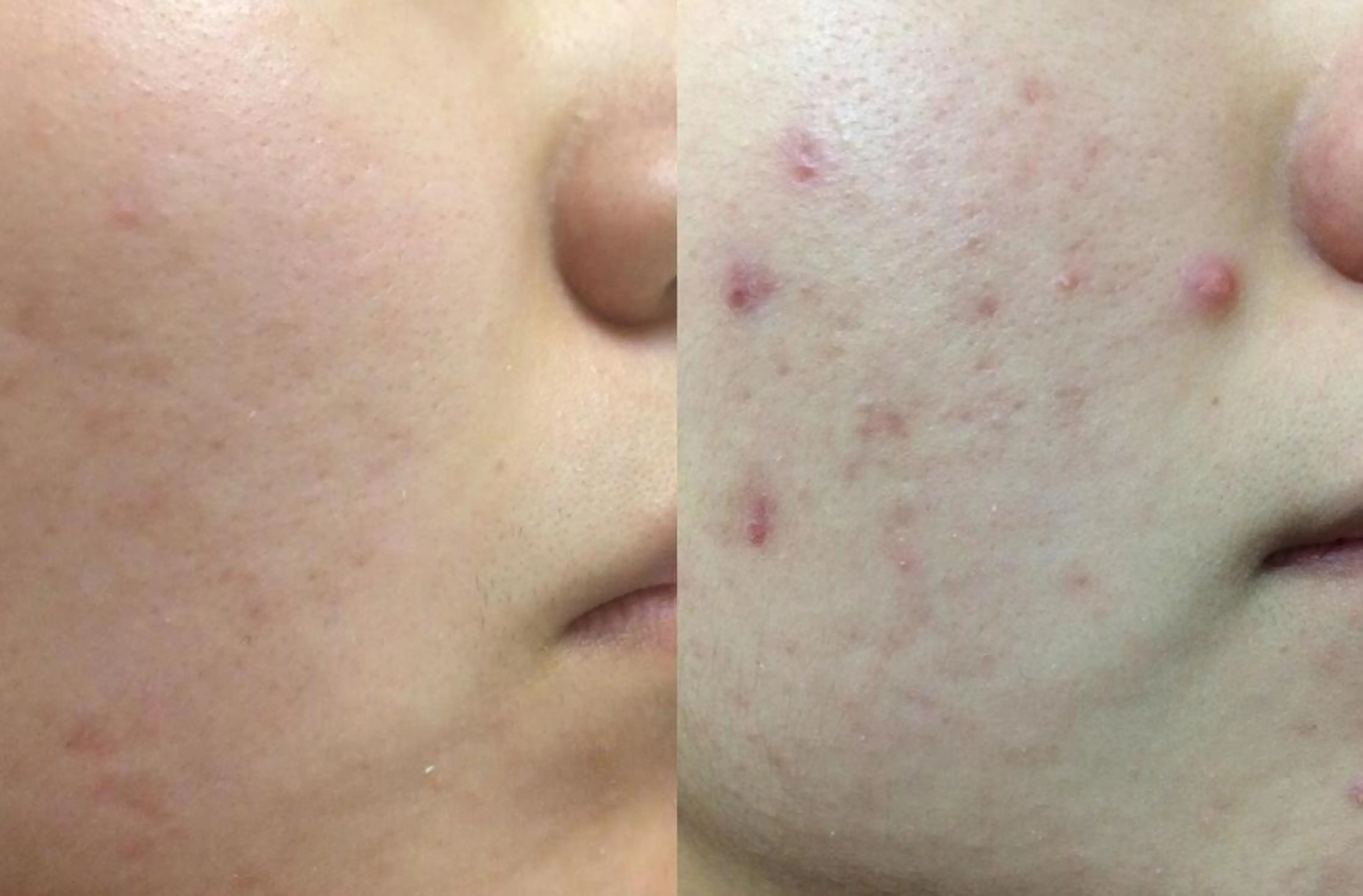 夏までに肌荒れ卒業 するサロン🌻のエステ・リラクイメージ