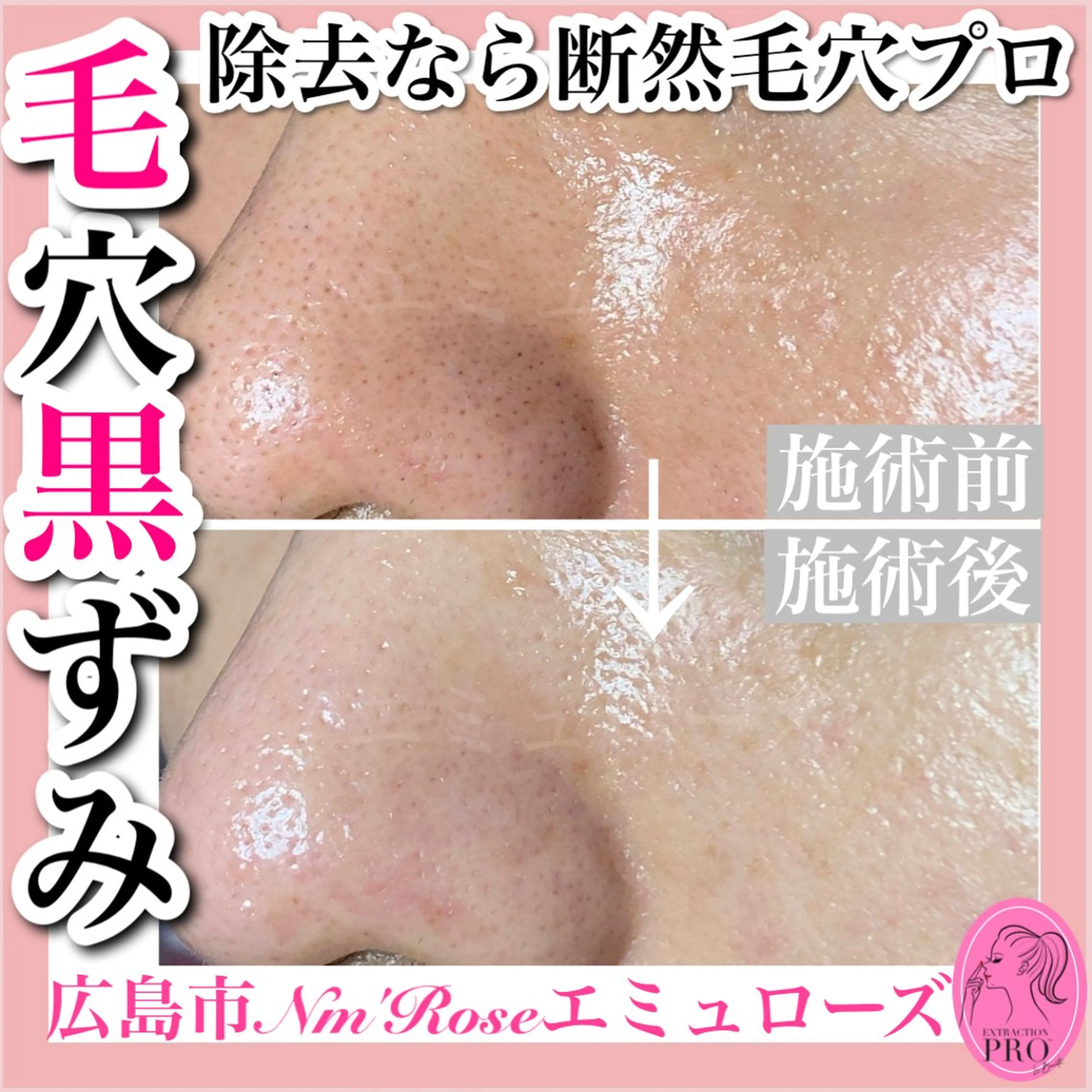 毛穴プロの極上毛穴美肌コースの写真