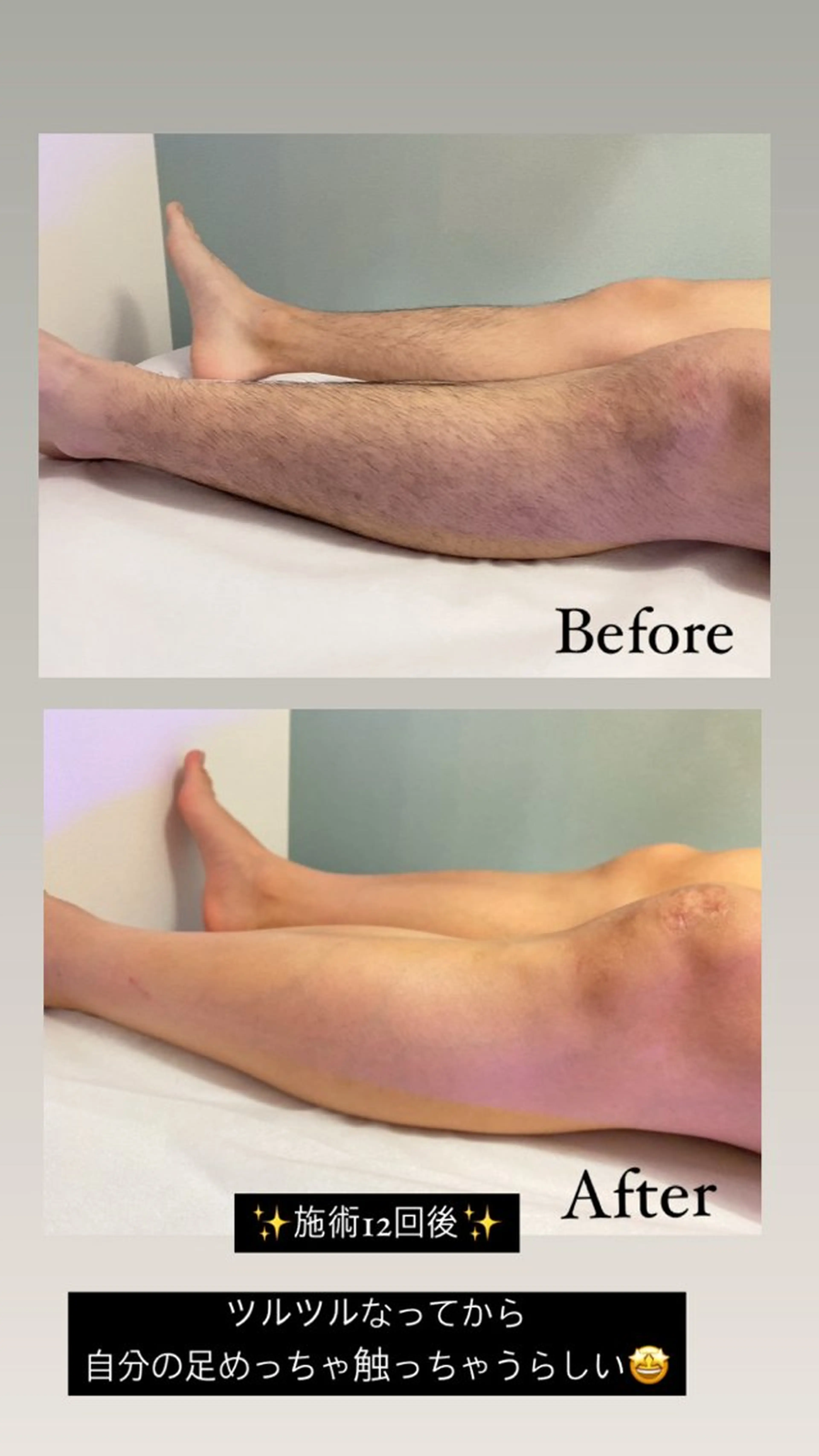 【学生・4月から新社会人限定】全身脱毛¥20,000→¥6,500の写真