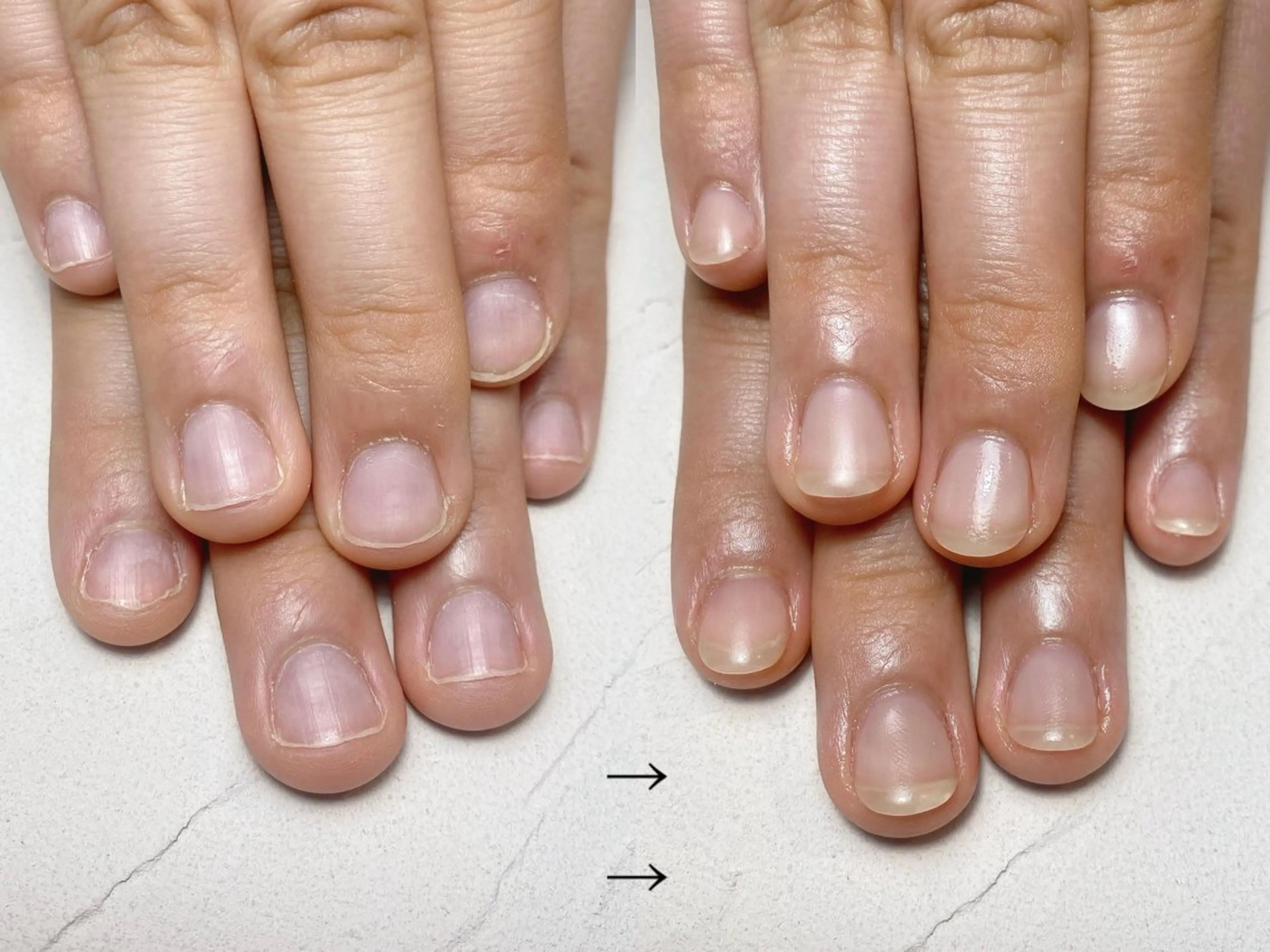 ◆メンズ◆ハンドネイル長さ出し10本/自爪風仕上げ/深爪矯正【ミニモ限定価格】の写真