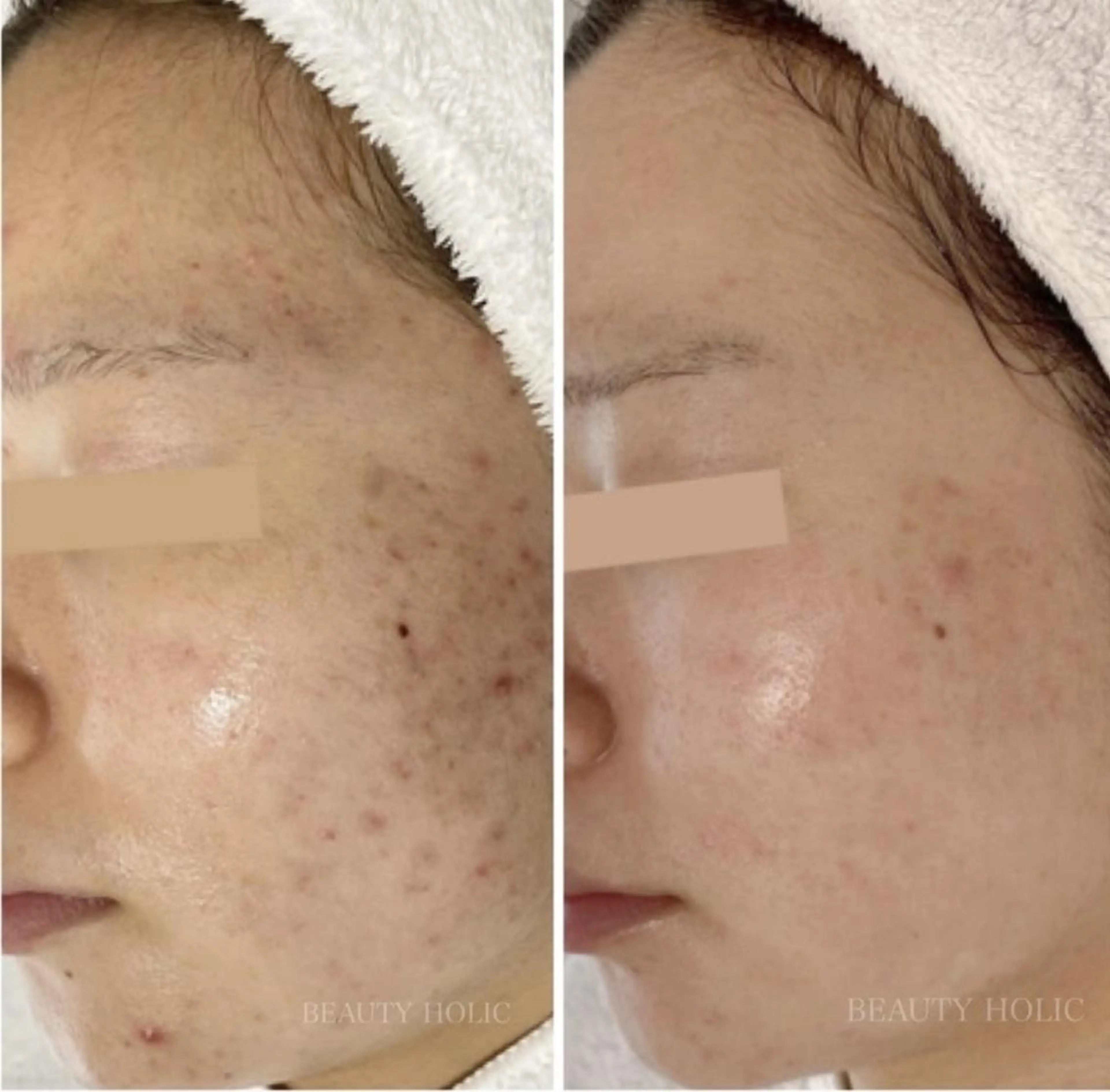 ニキビ・ 肌荒れ専門店のエステ・リラクイメージ