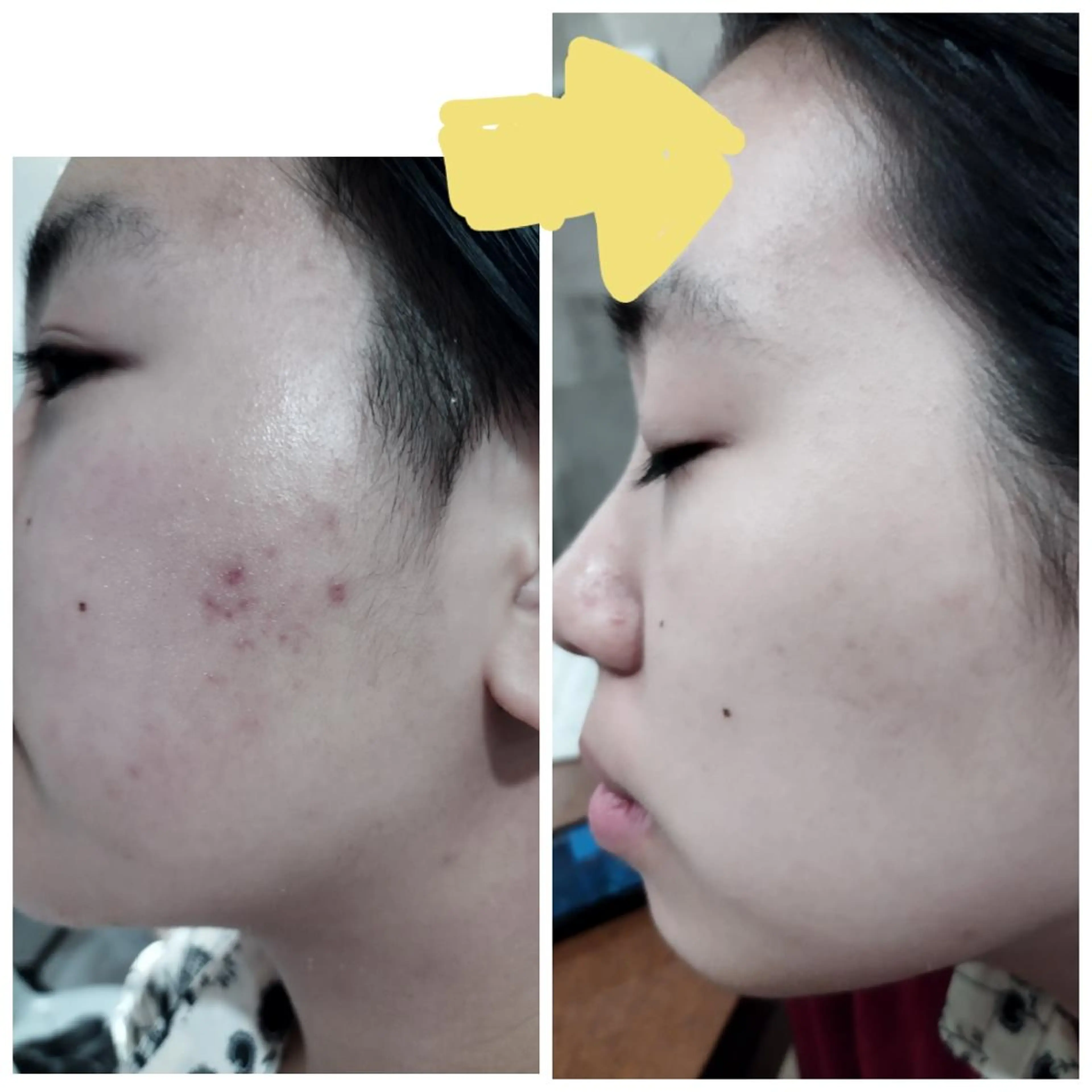 【美白より先の発光肌】低刺激で高い効果😉ニキビのお悩みにも。一度で透明感アップ✨芸能人ピーリングと話題の水光ピーリングの写真