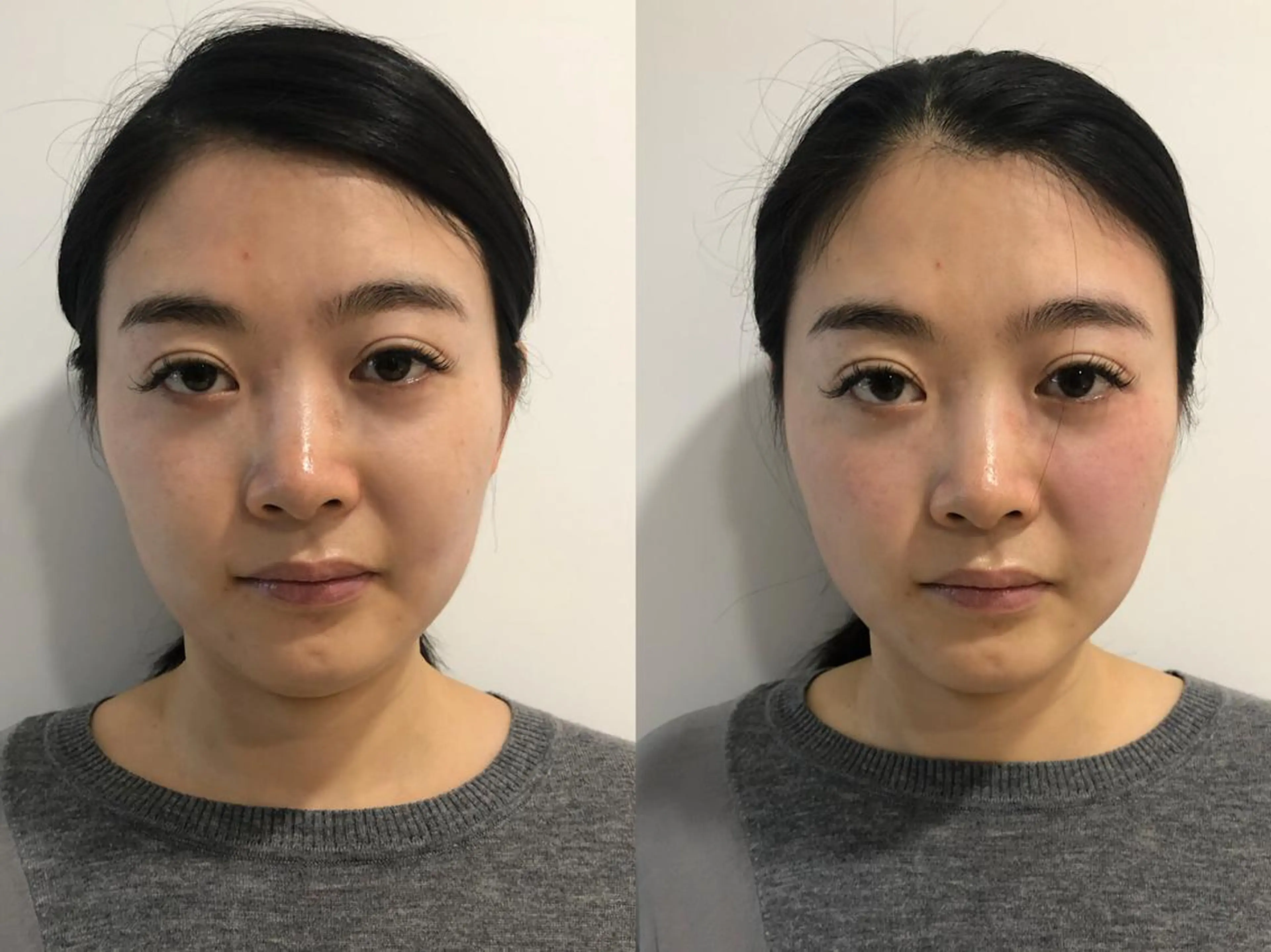 美容鍼・小顔/ 骨盤矯正/目黒/レンのエステ・リラクイメージ