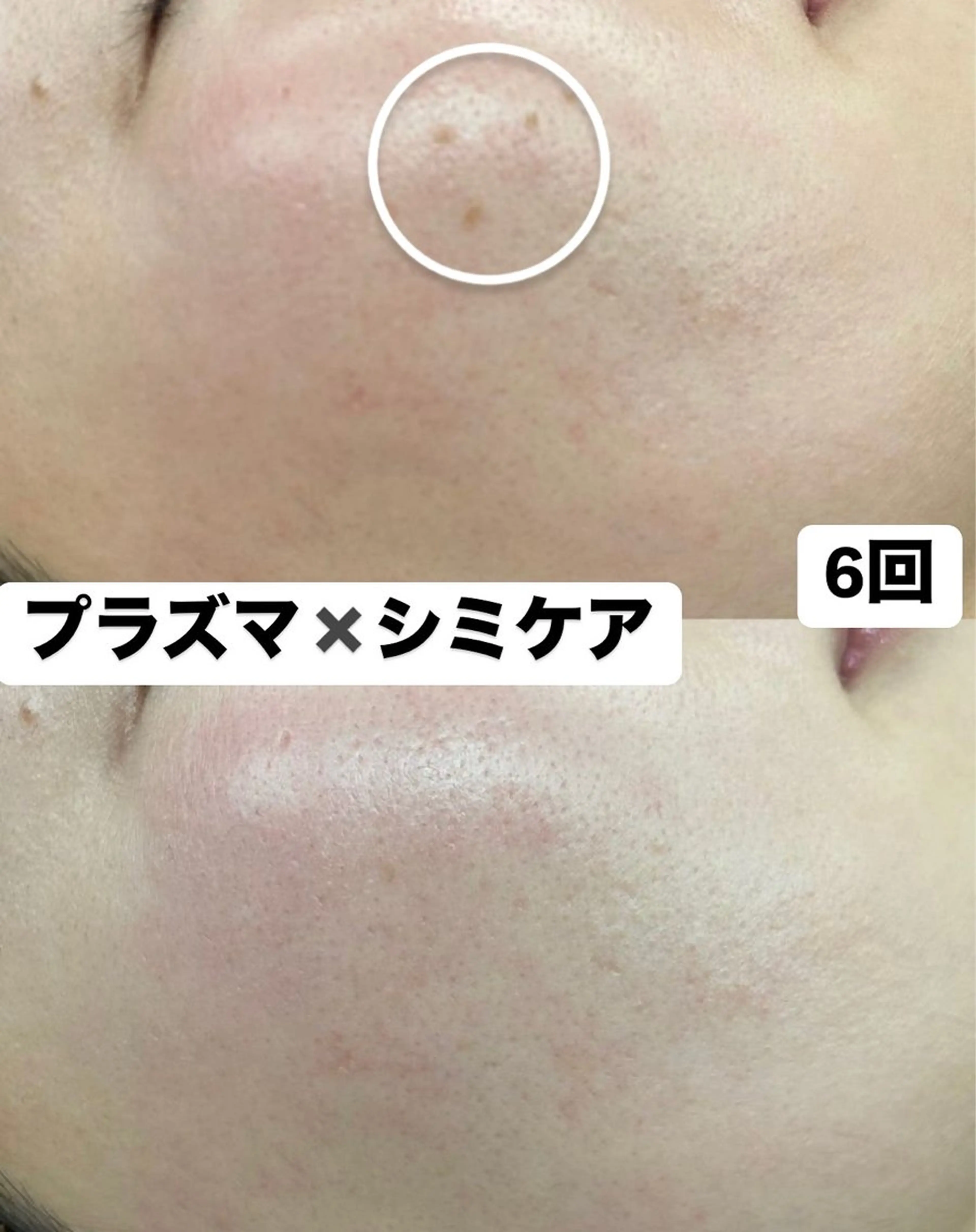 【徹底シミケア 10分】プラズマ導入✕美白トラネキサム酸導入透明感UPの写真
