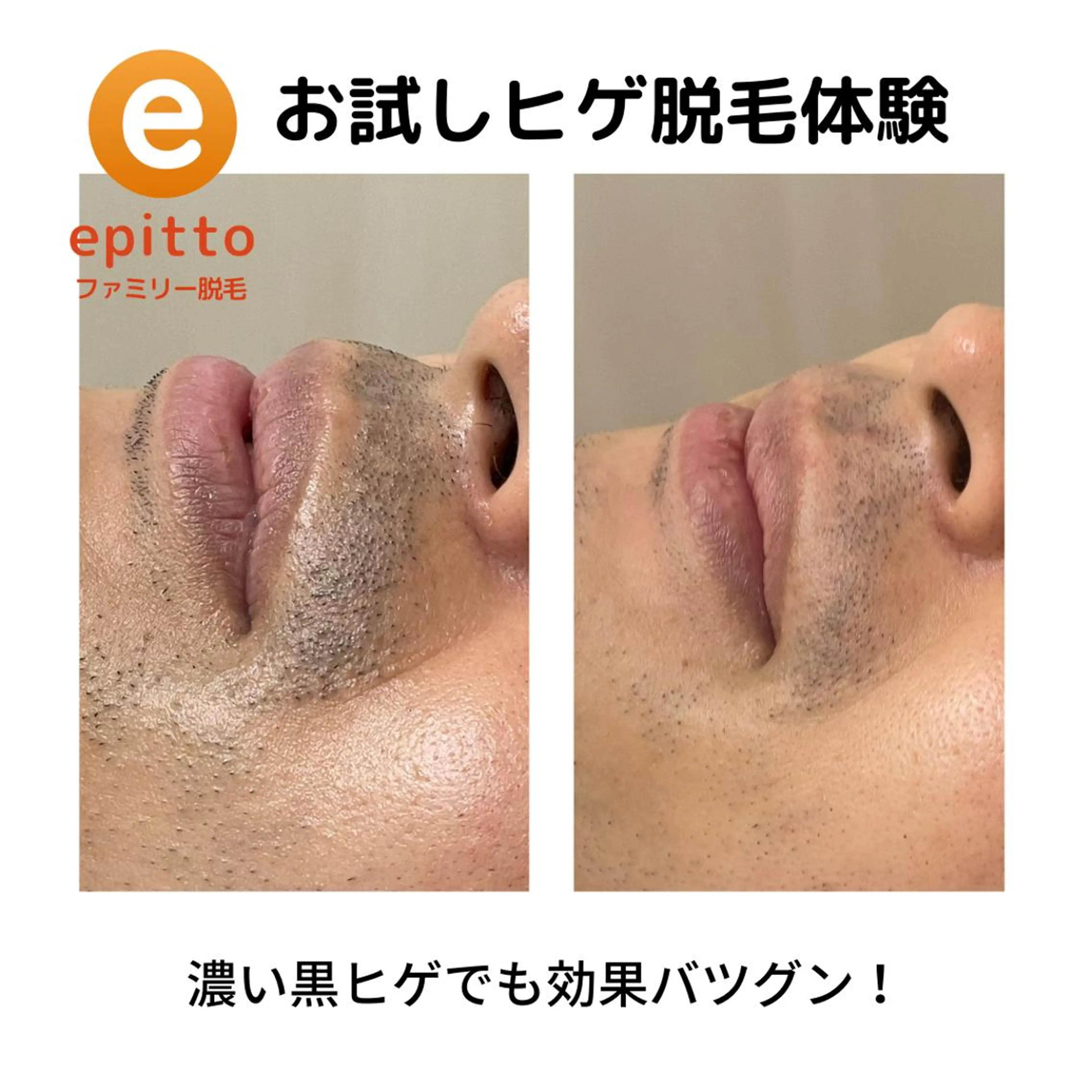 【NPL方式でバッチリ快適♪ヒゲ脱毛】初回2回体験3,980円!濃いおヒゲに自信あり☆の写真