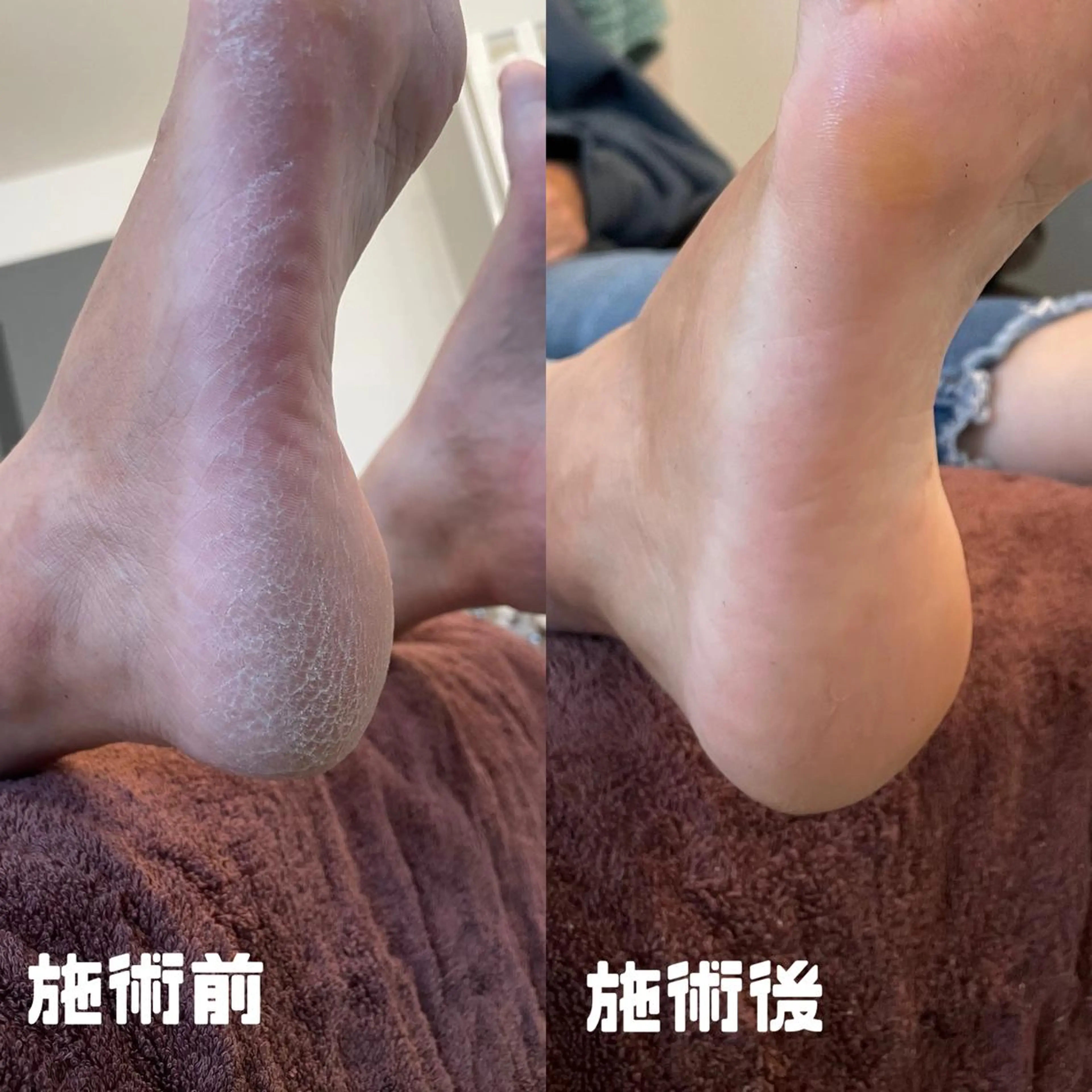 フットケア角質除去の写真