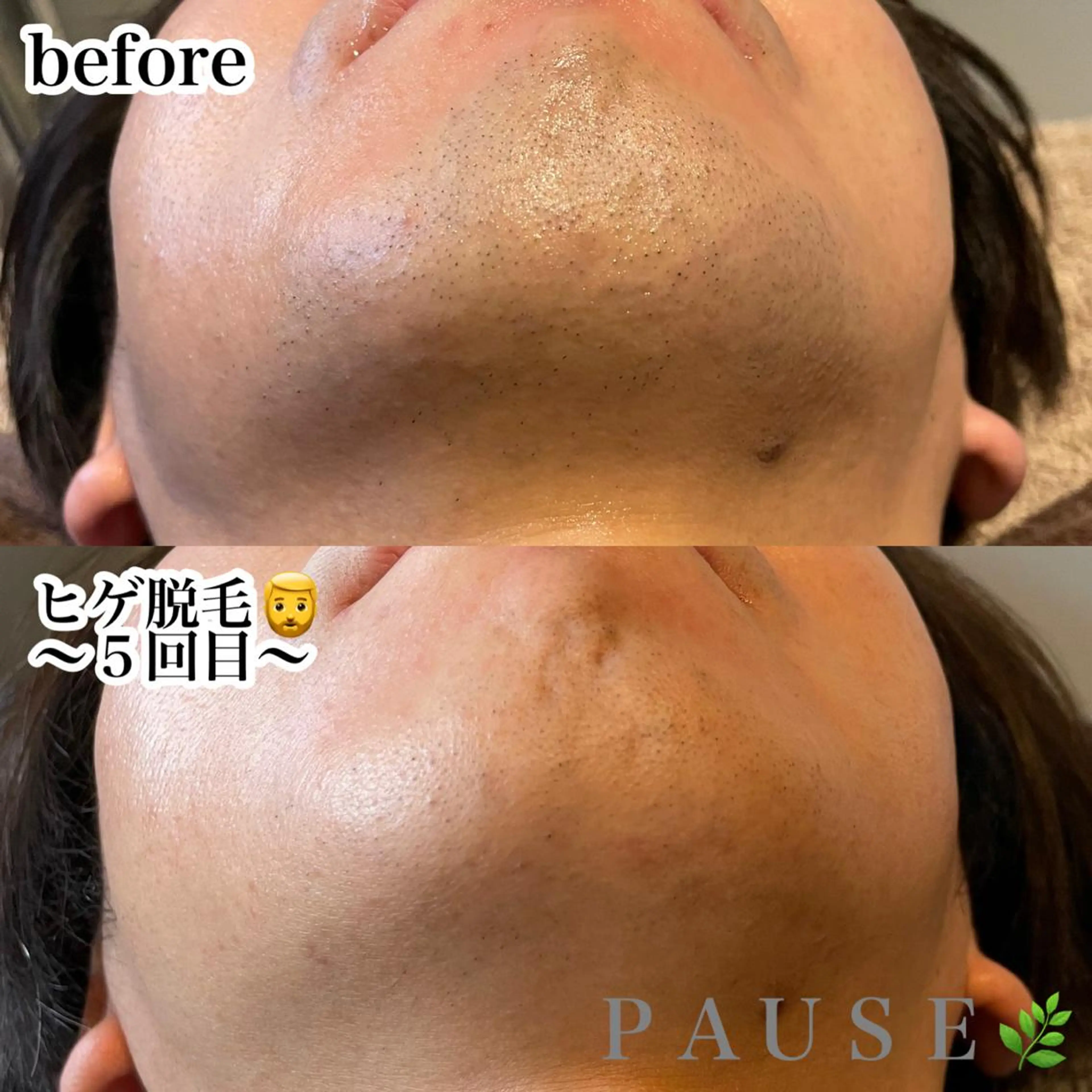 🥸メンズ脱毛🥸ひげALLセット一回コースの写真