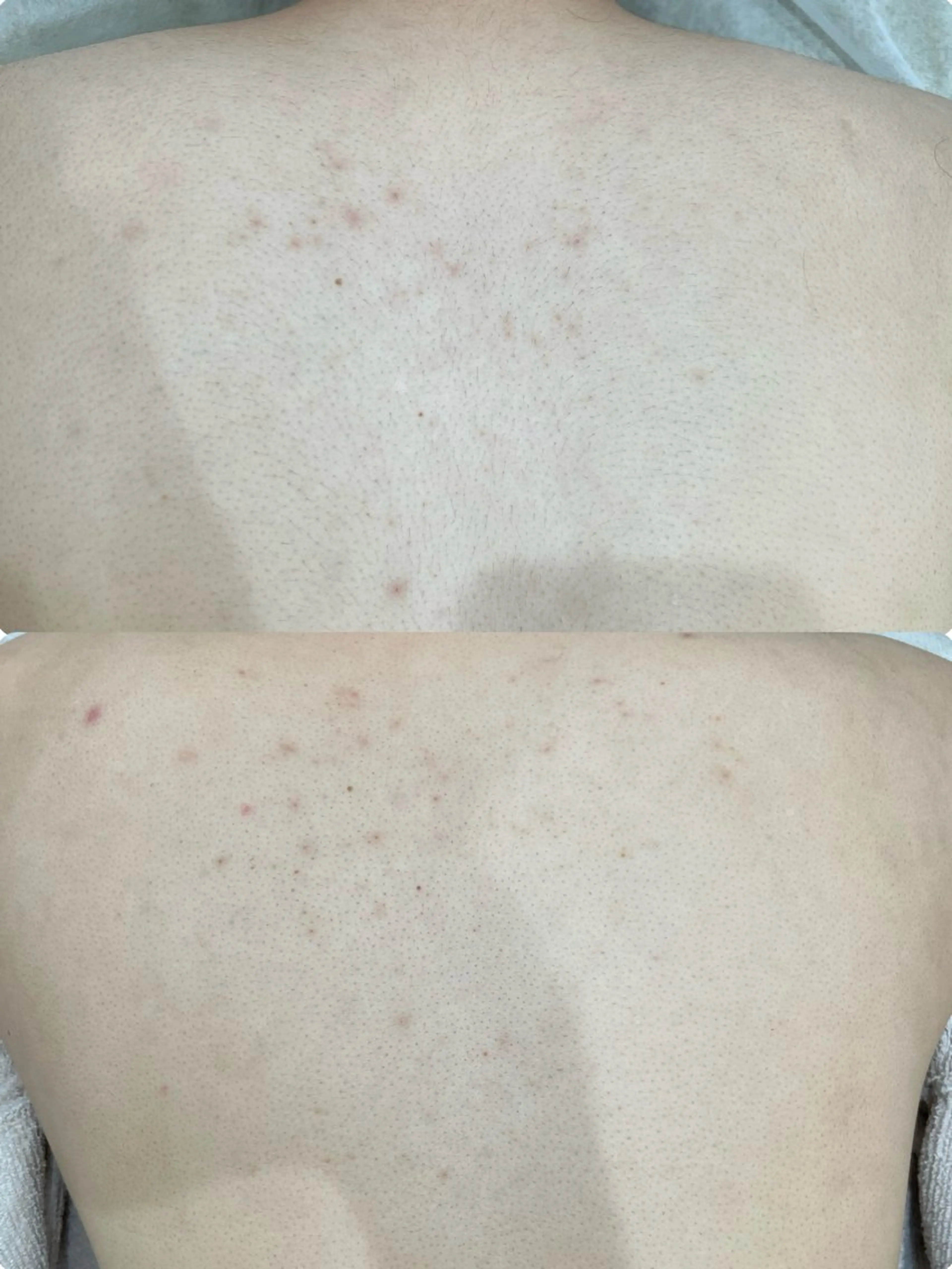 [イベント前に🎈] うなじ背中脱毛⭐️の写真