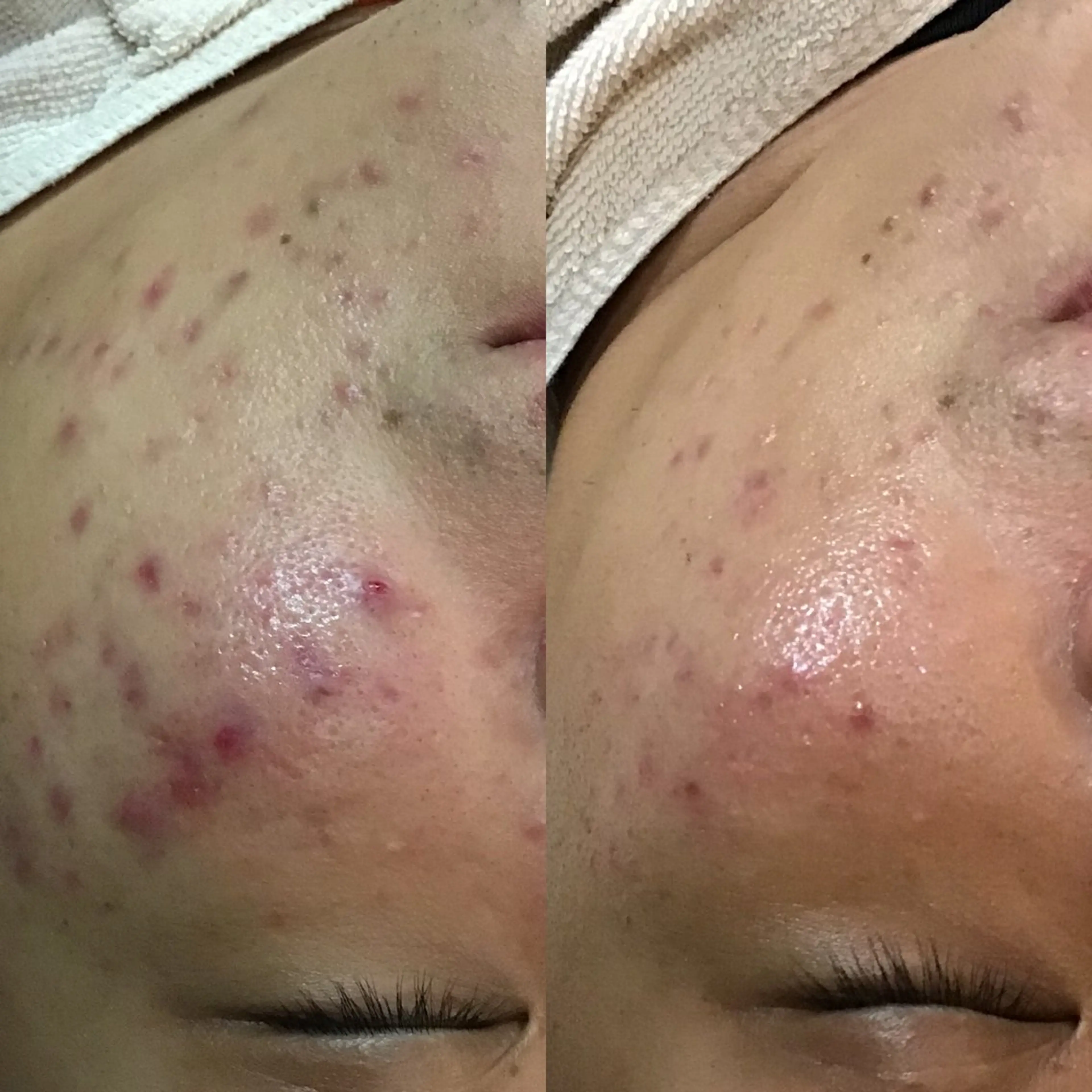 ニキビ、肌荒れ改善フェイシャルの写真