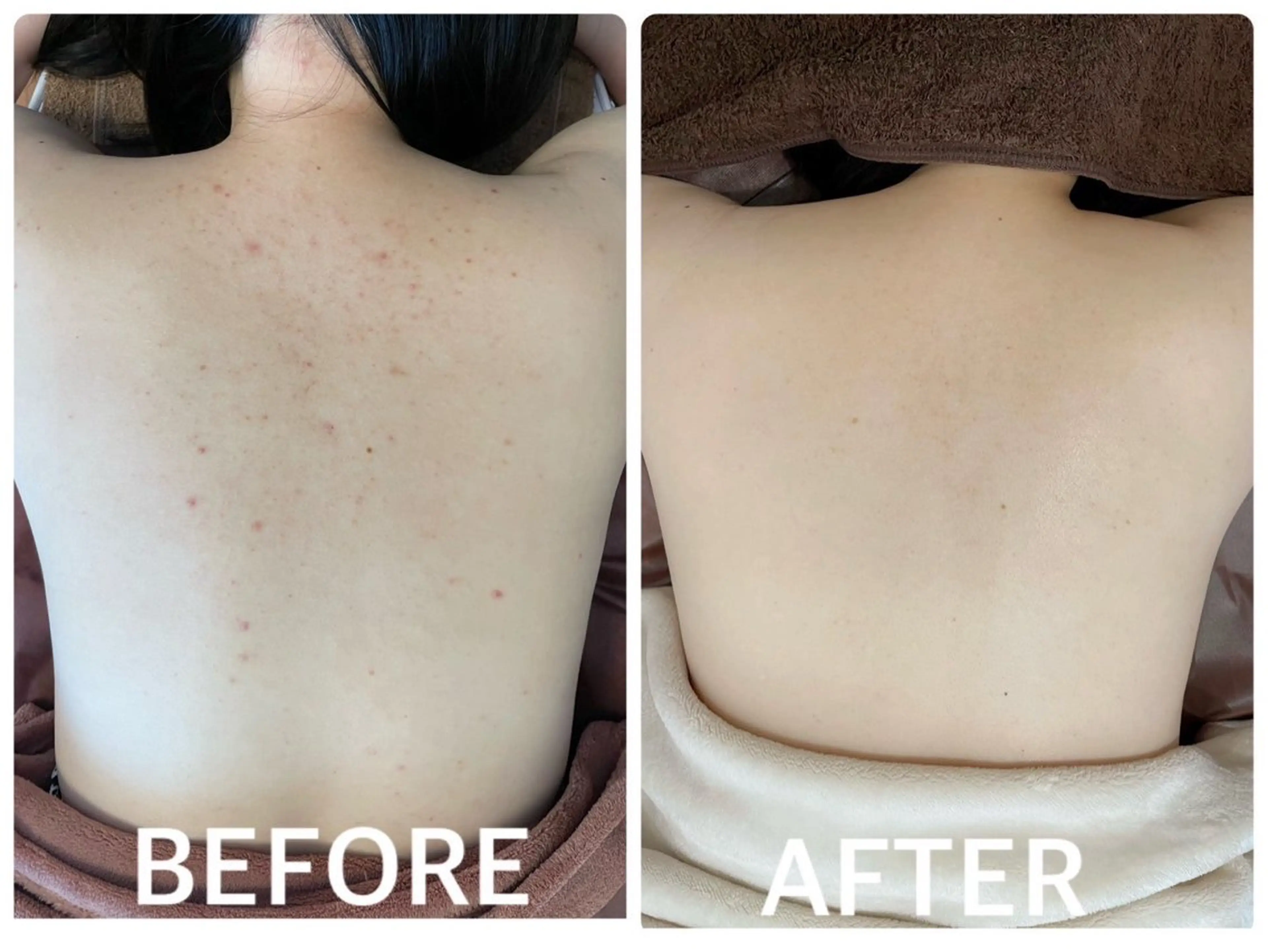 《肌荒れ特化》2B×ドクズハーブピーリングで徹底リセット🌿ニキビ・赤み・敏感肌に◎💫 肌の土台からケアしたい方への写真