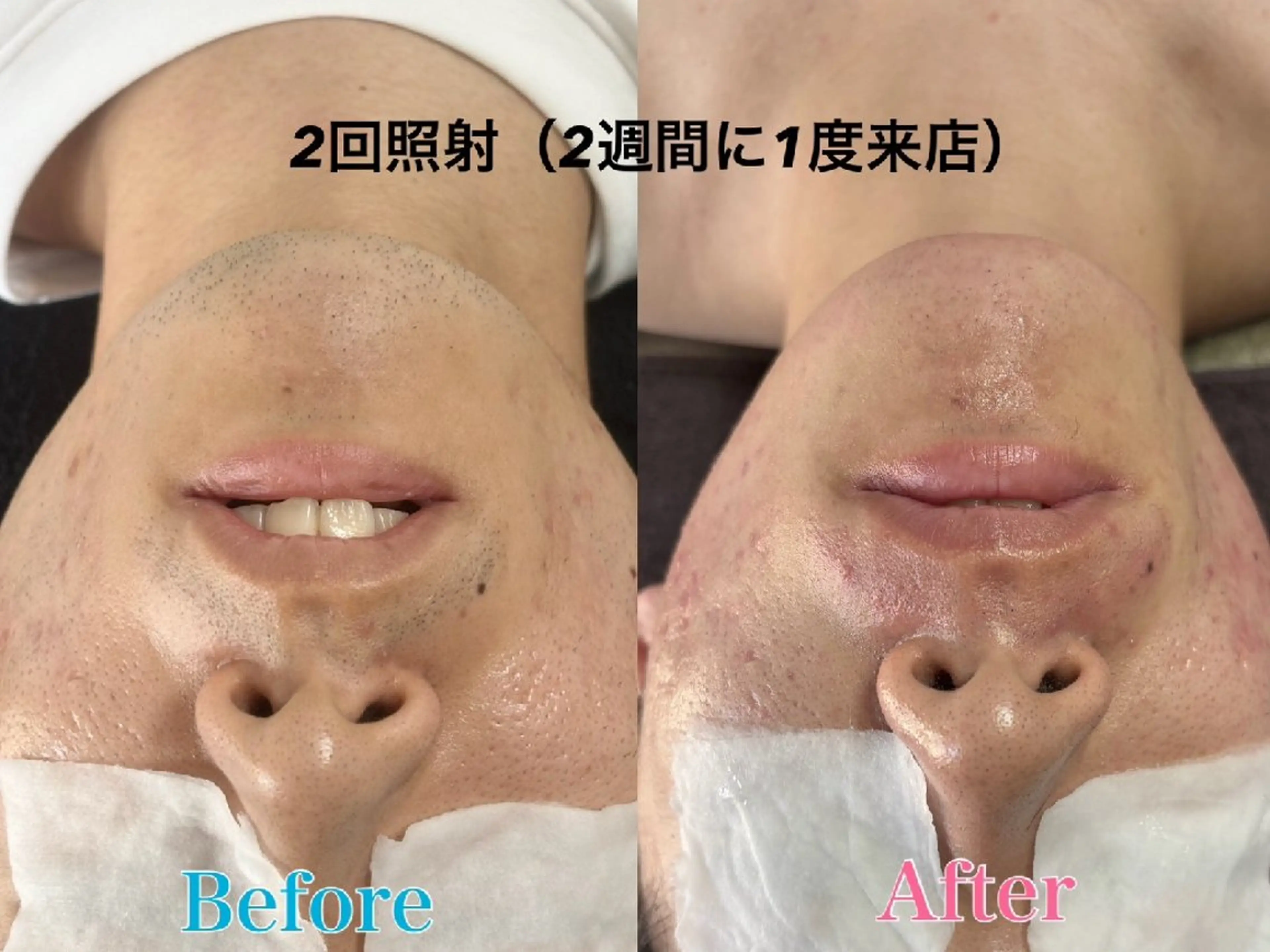 メンズ 脱毛 totalbeautysalonLisse所属・Lisse ネイル/ 脱毛/アイブロウのネイルデザイン