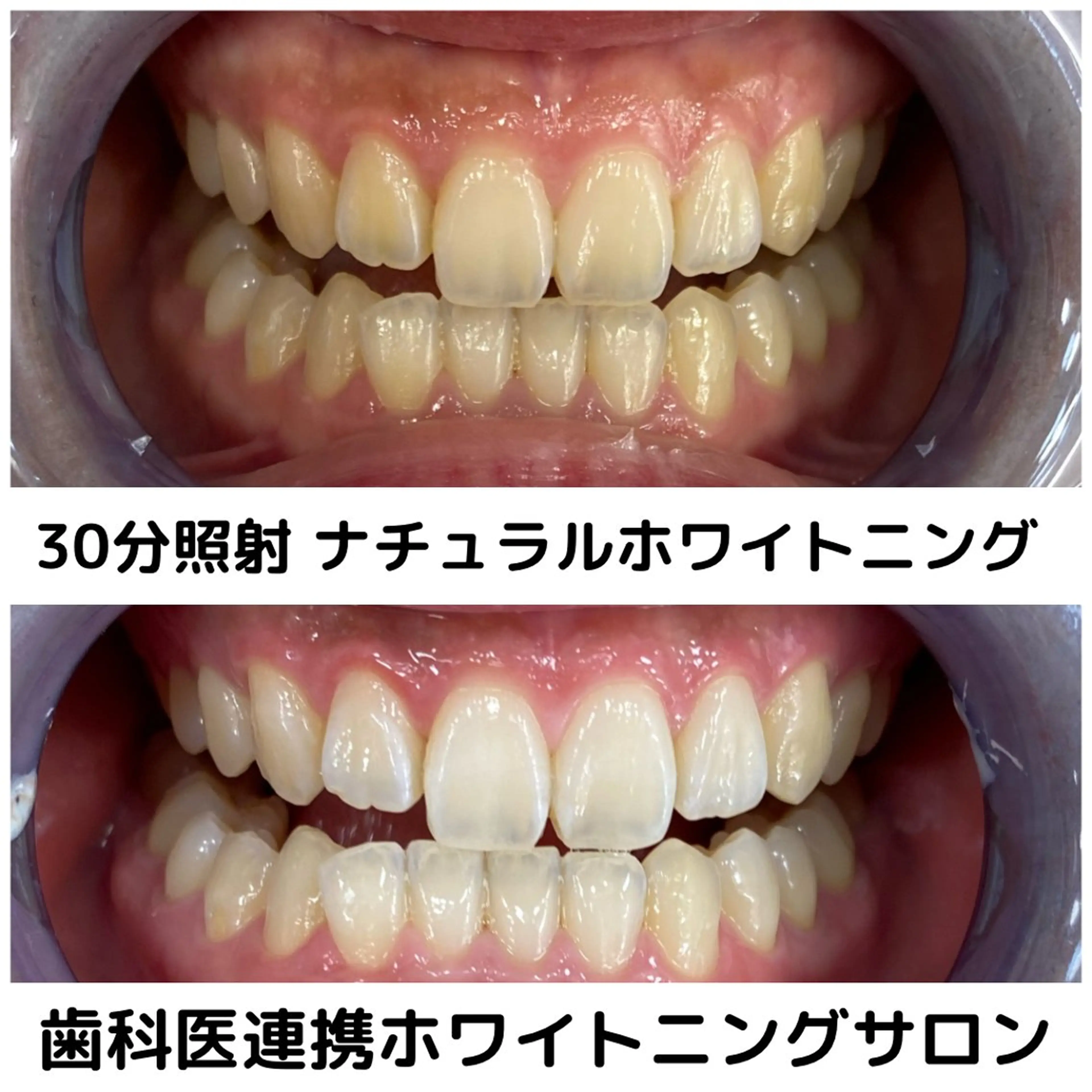 クリスマスキャンペーン🎊一度で必ず効果を実感できる❣️初めての方は一度ご体験ください🦷✨初回30分照射‼️の写真