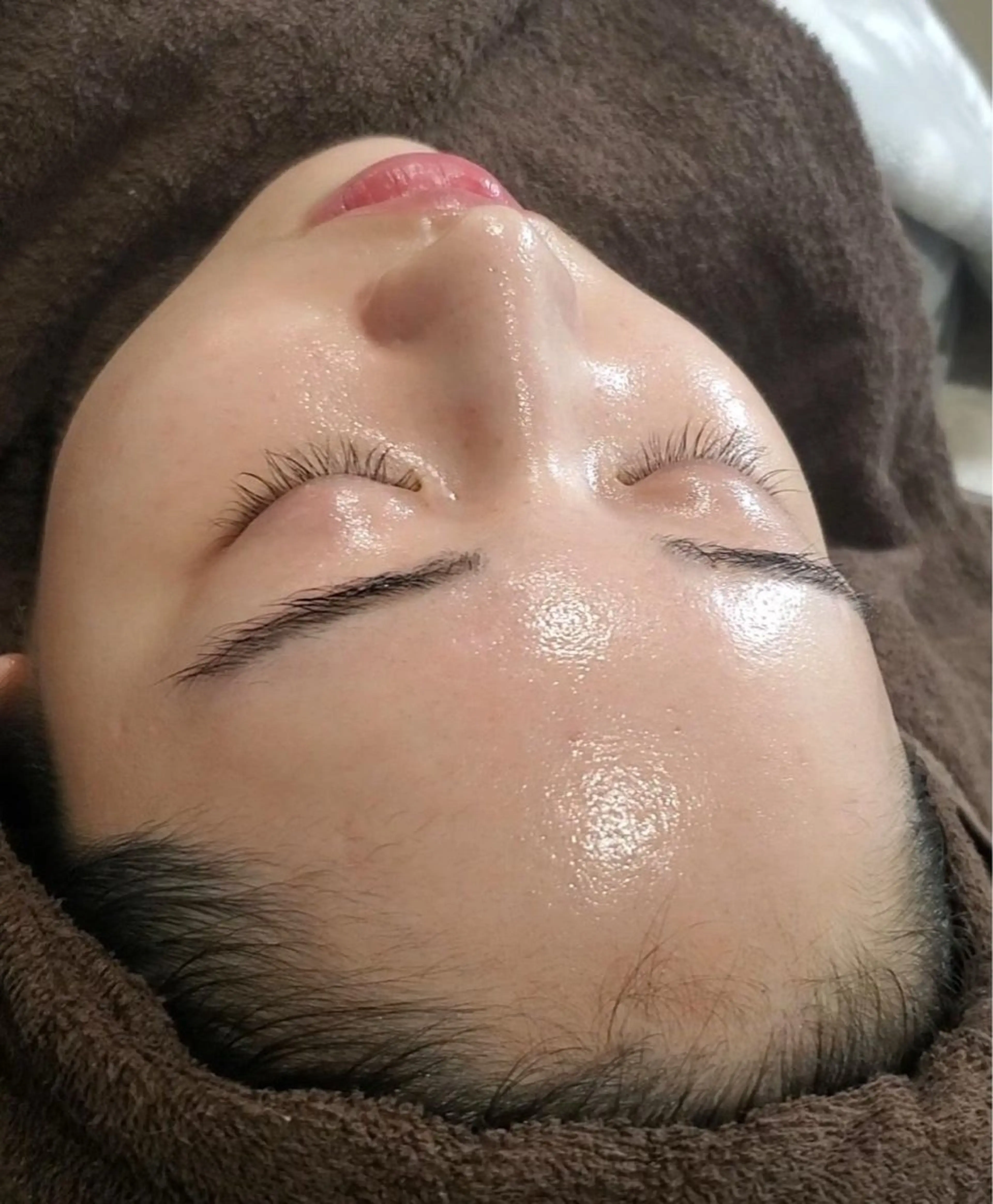 【肌荒れ・ニキビ・ニキビ跡】イオン導入&剥離なしハーブピーリング🌿の写真