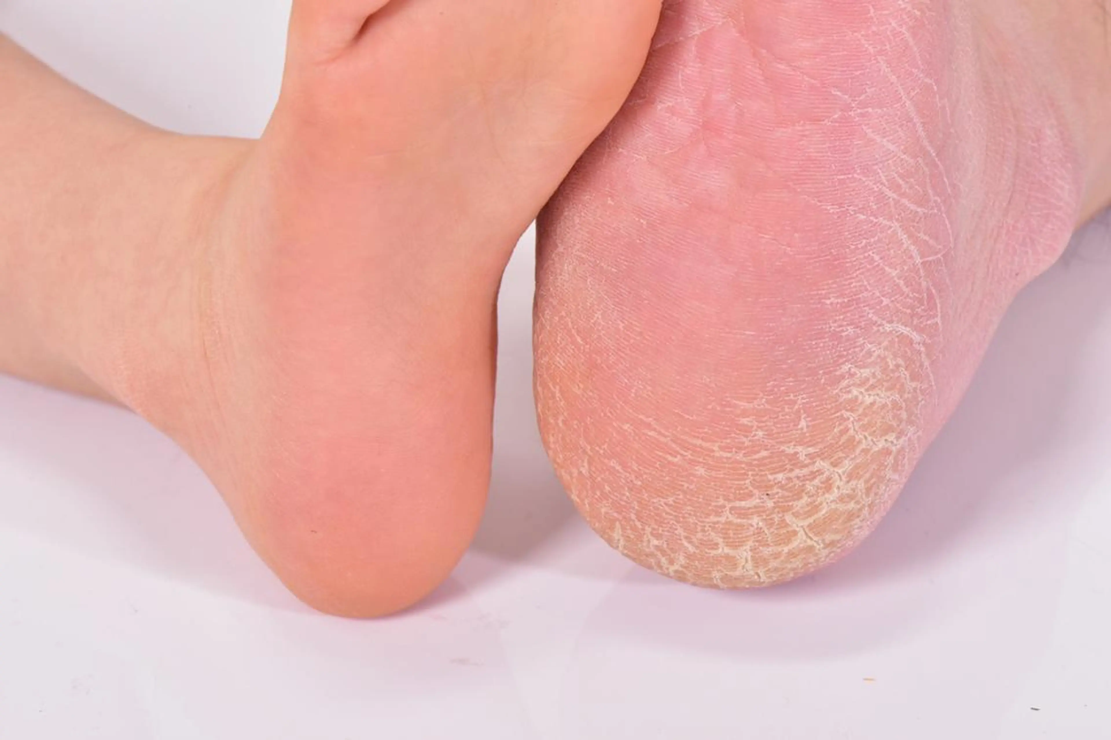 足裏＆かかと もちもち♪FOOT角質ケア保湿仕上げ￥3630の写真