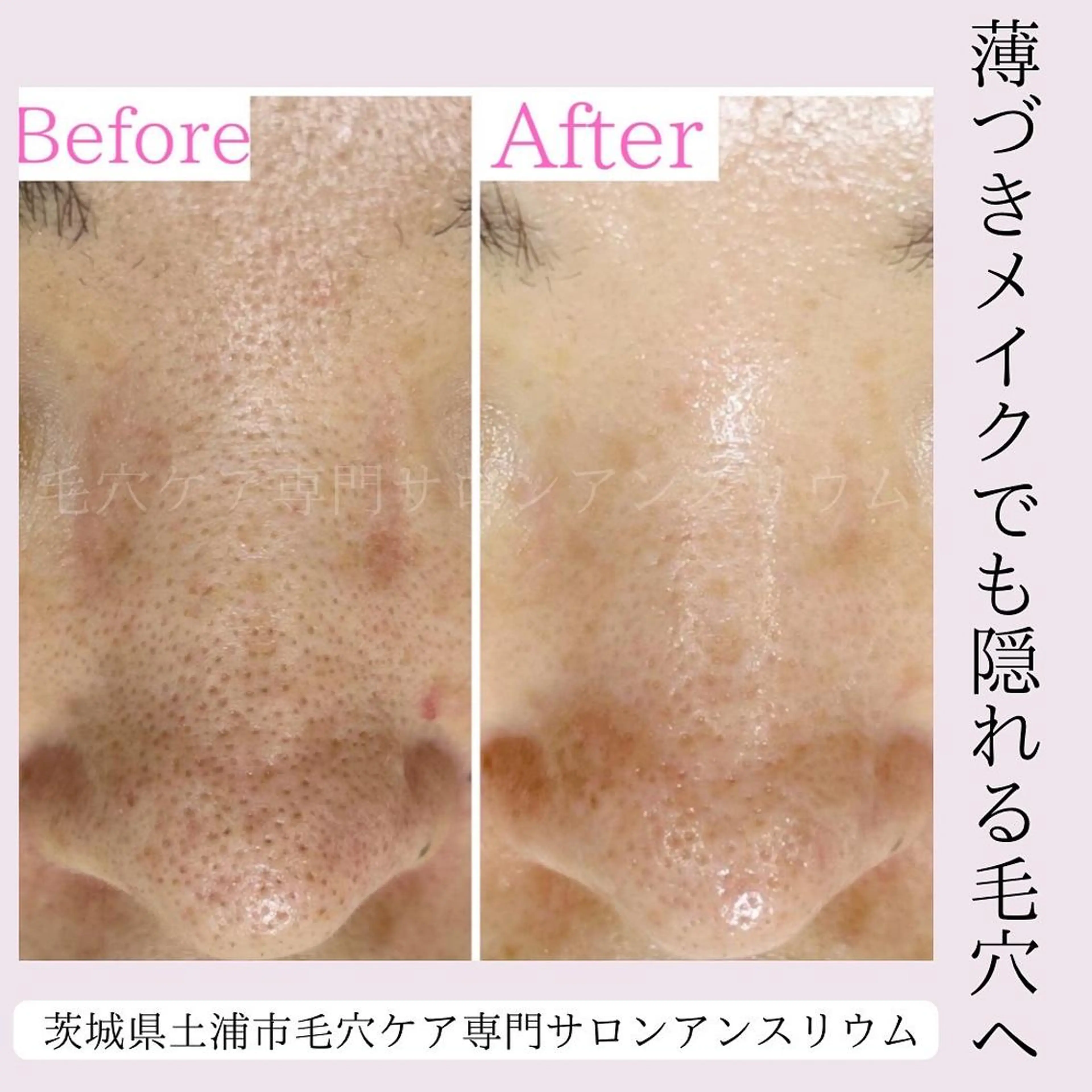 毛穴ケア専門サロンアンスリウム所属・茨城土浦 つくば毛穴 ケア専門サロンのエステ・リラクイメージ