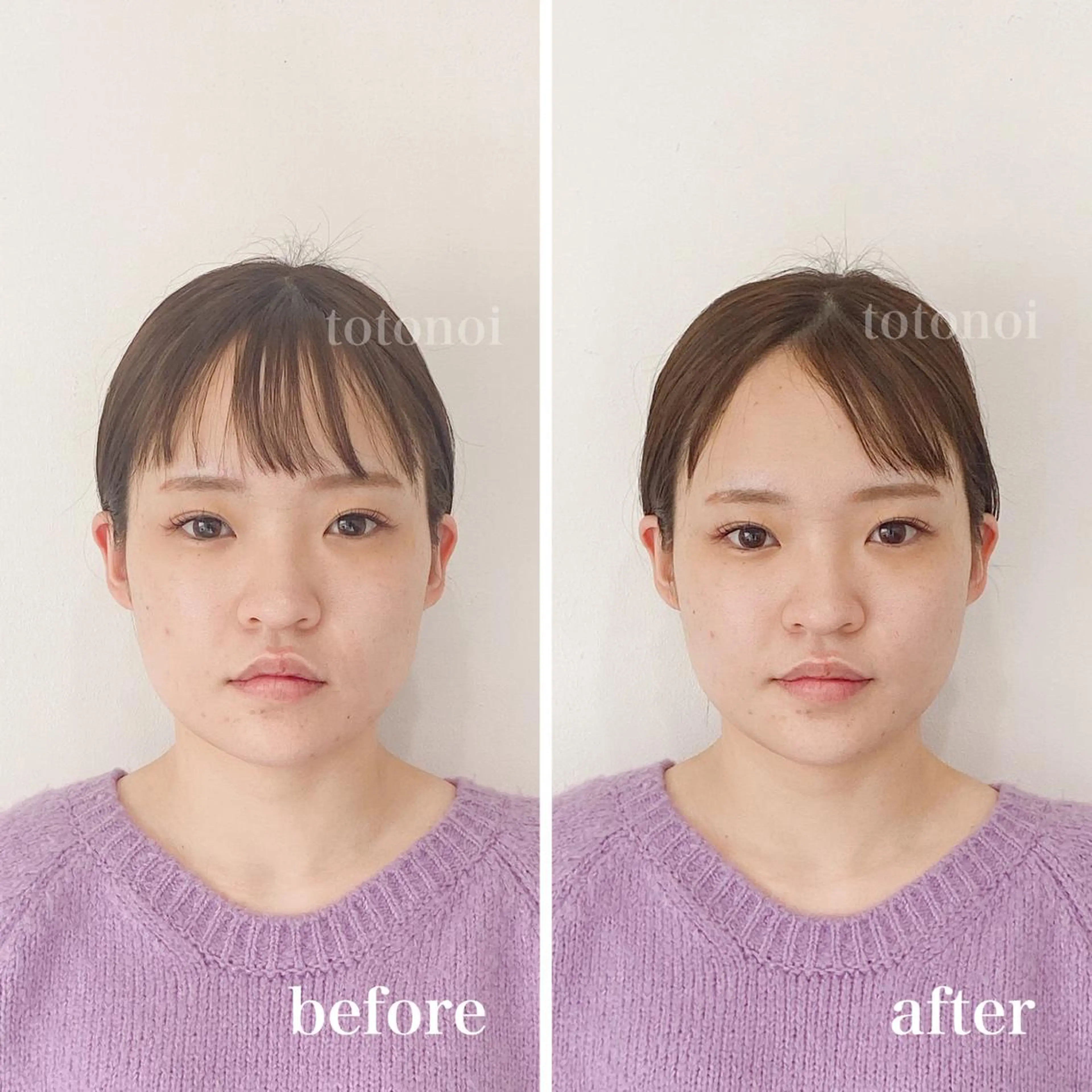 はり灸サロン　totonoi所属・印象の良くなる 美容鍼のエステ・リラクイメージ