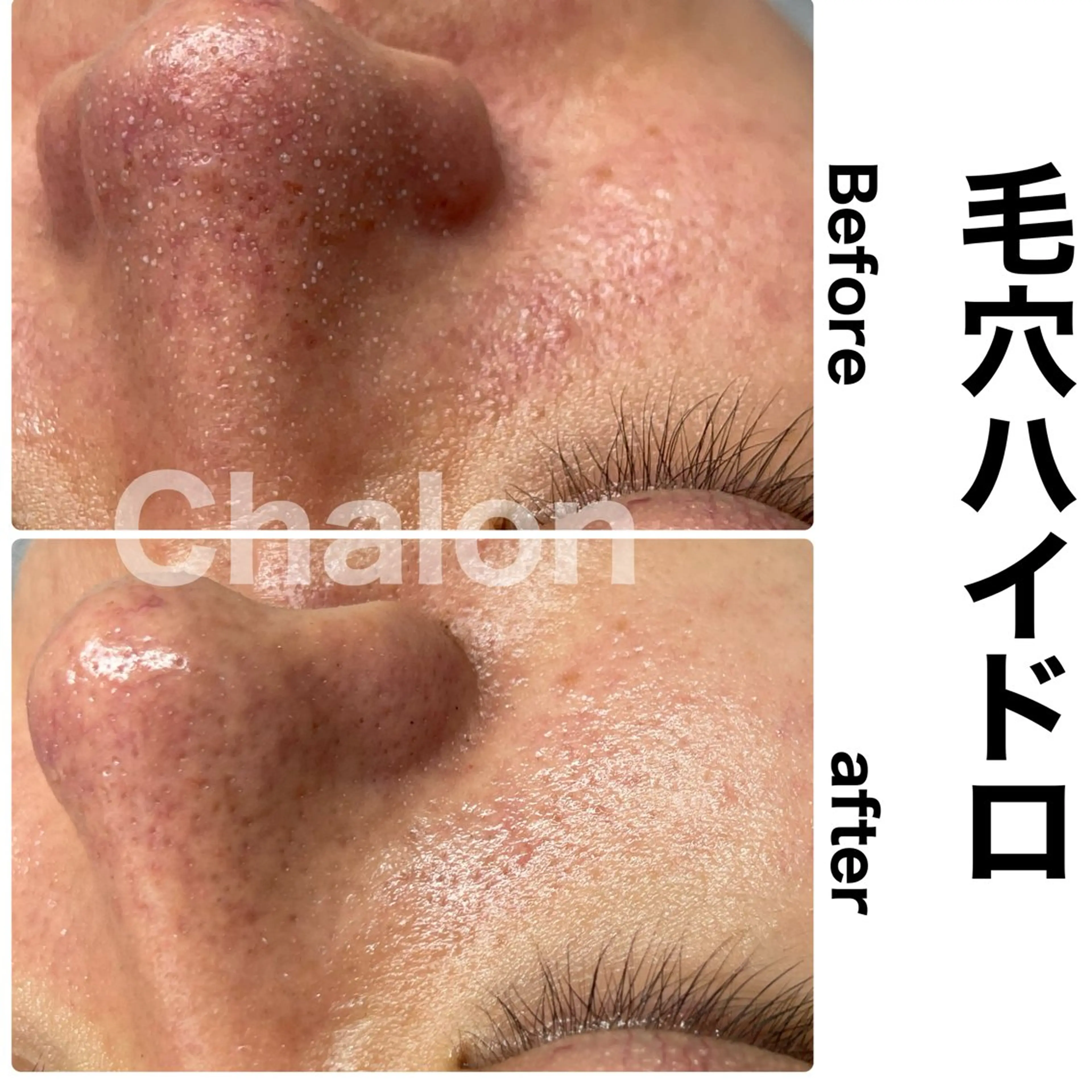 エステ Chalon所属・REVI取扱・肌悩み 毛穴Chalonのエステ・リラクイメージ