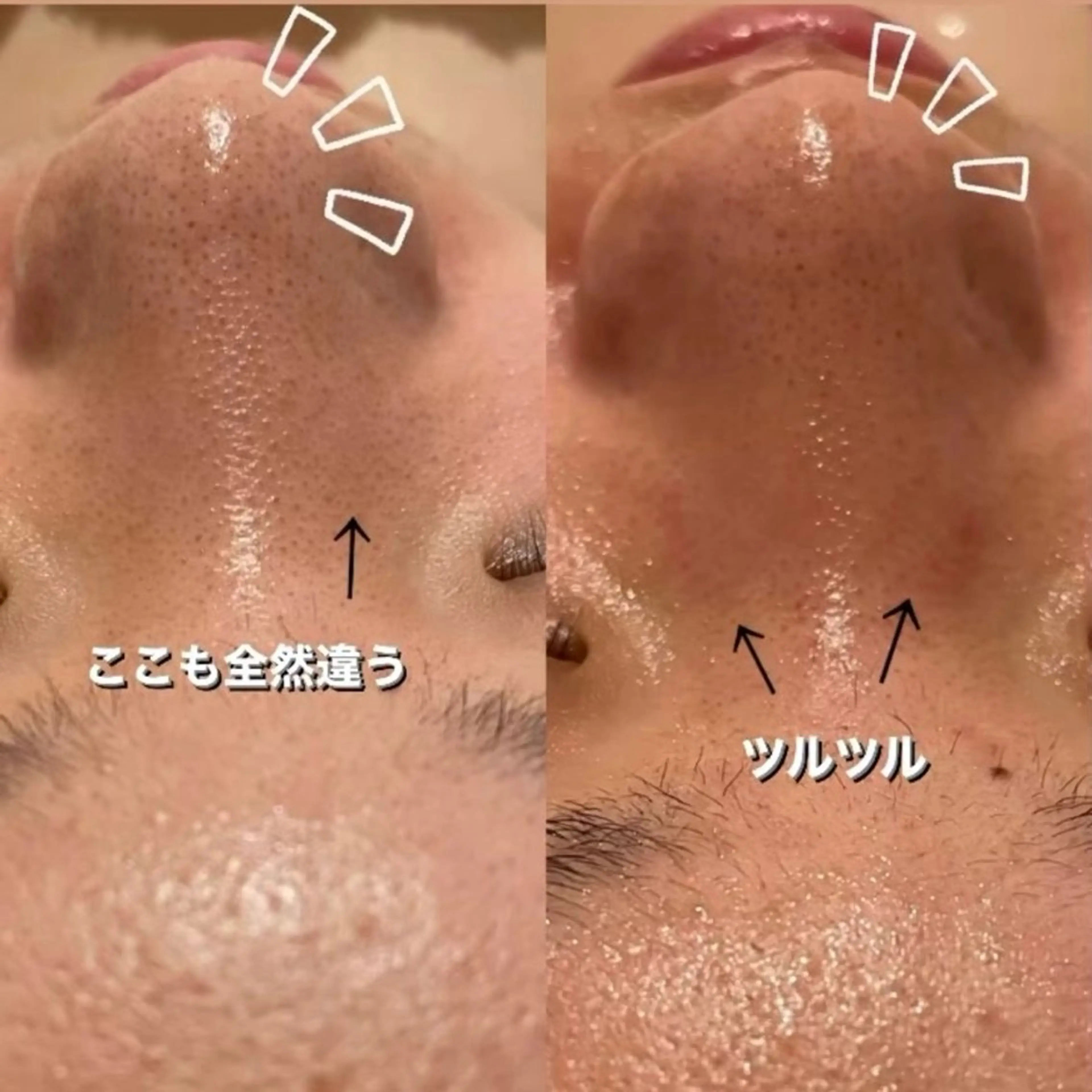 【つるんとスッキリ肌】乾燥・毛穴の黒ずみ・透明感ケアの写真