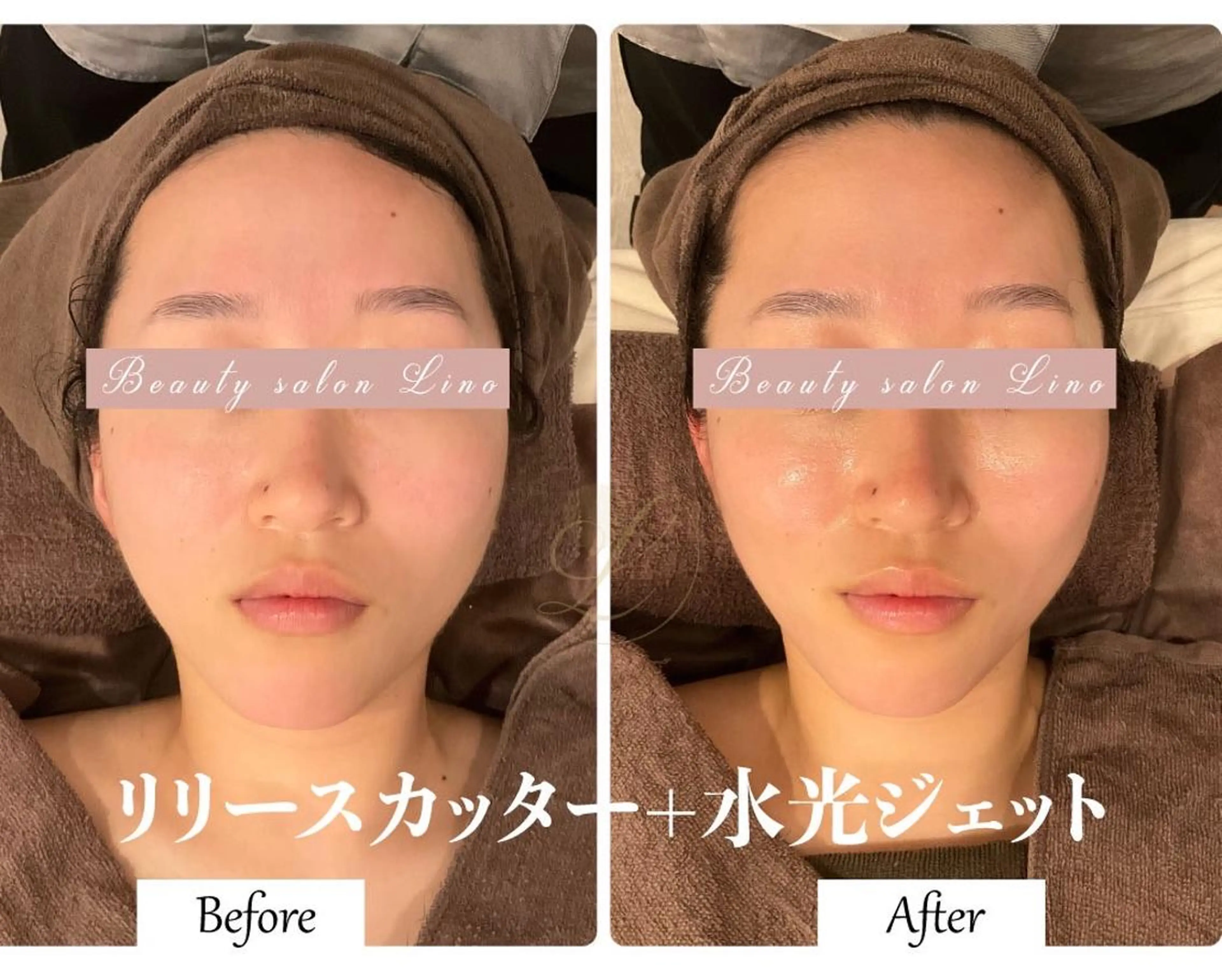 【ブライダルエステ👗】フェイシャル&シェービング★結果重視★小顔リフト・輝く水光肌・透明感♪の写真