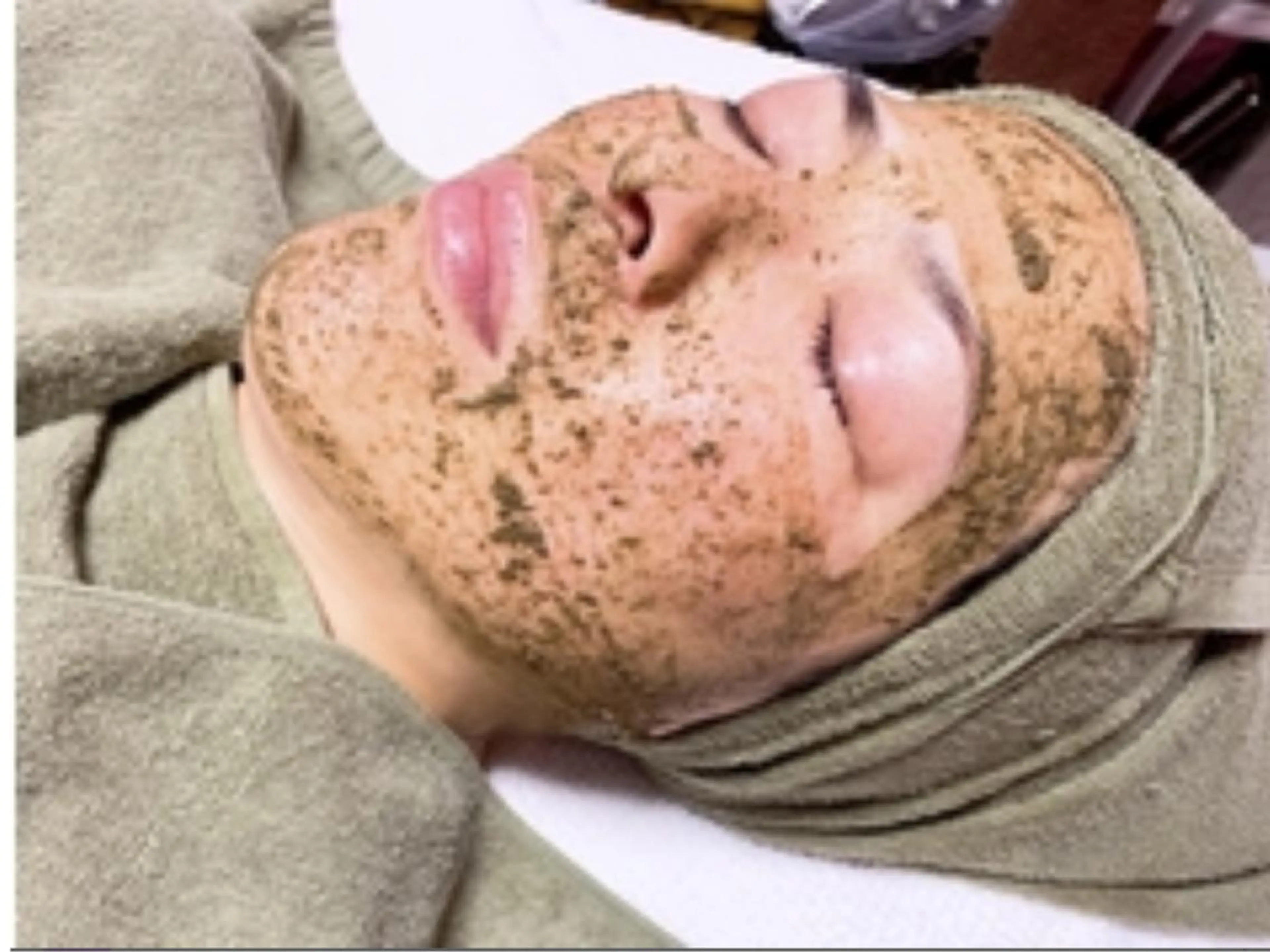 【陶器肌ピーリング】元祖ハーブリプロ🌿afterトリ定価33,000→￥25,000口コミ投稿／写真投稿OKな方‼️の写真