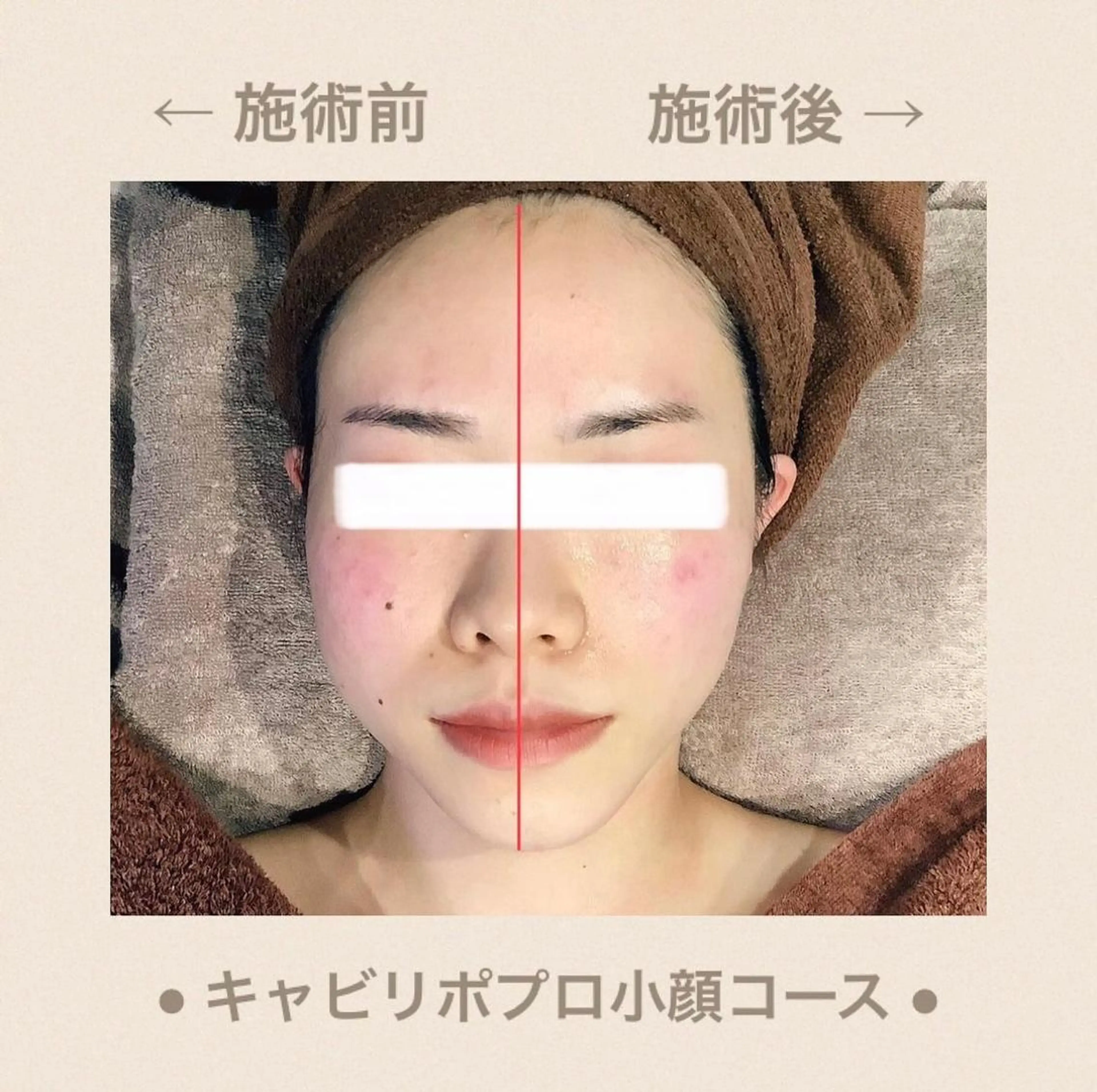 切らない糸リフト💆🏻‍♀️🔥 【 超小顔 】の写真