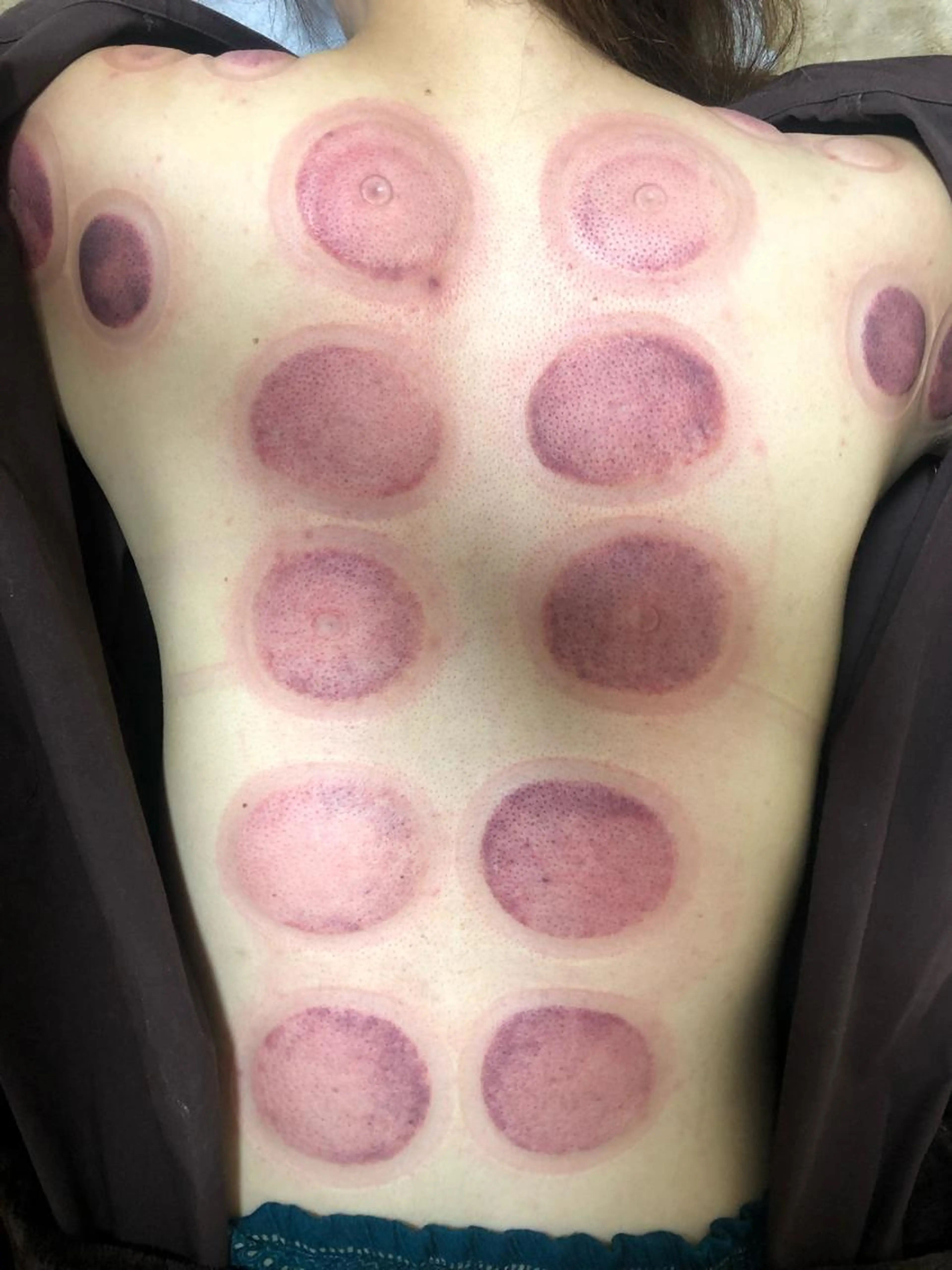 吸玉（カッピング）＋マッサージ✨の写真