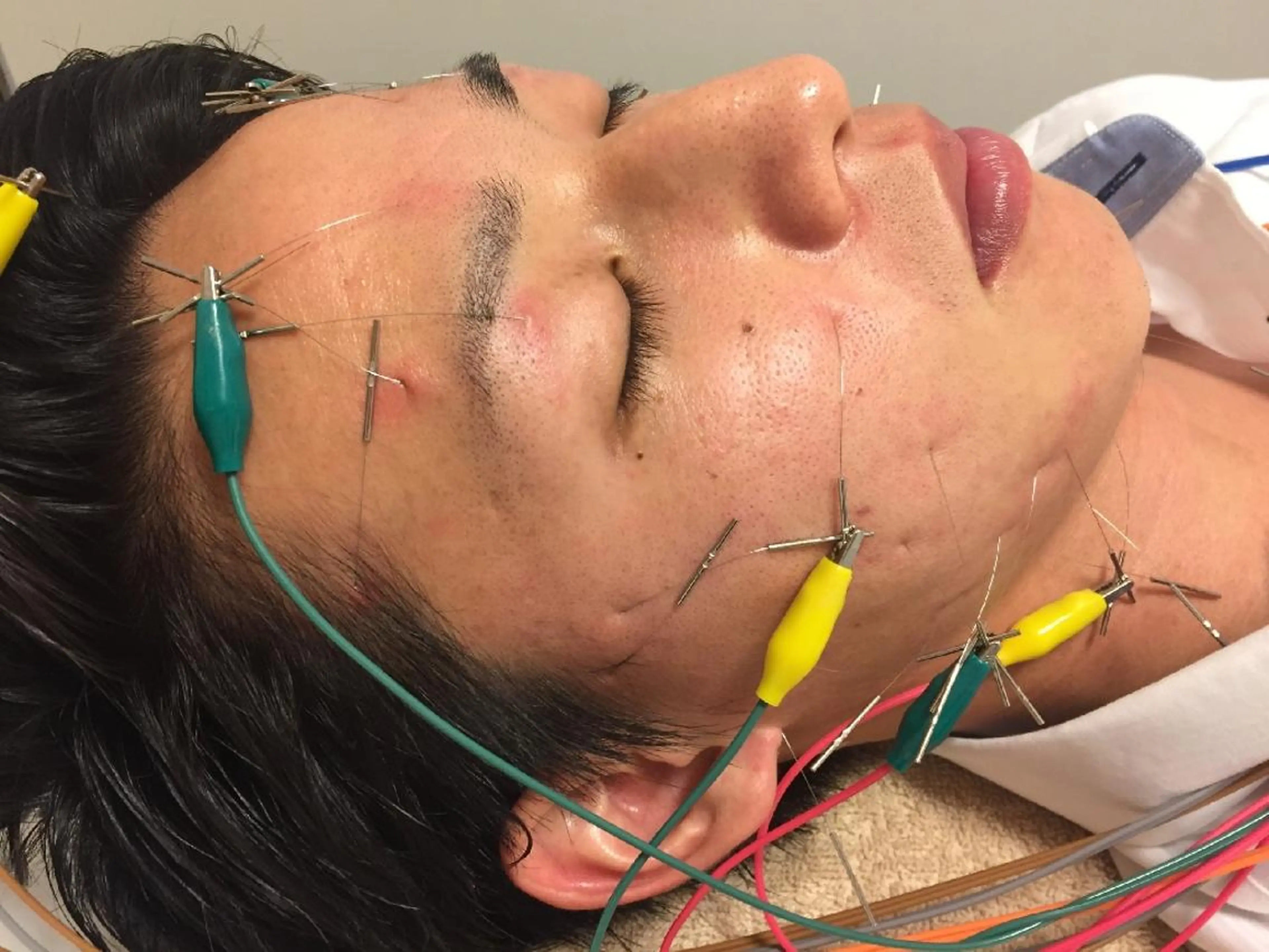 🧡電気を流すメンズ美容鍼【初回​〜​1ヶ月以内】🧡美容は勿論ですが、お仕事での目の疲れや頭の重さ改善に繋がります🧡の写真