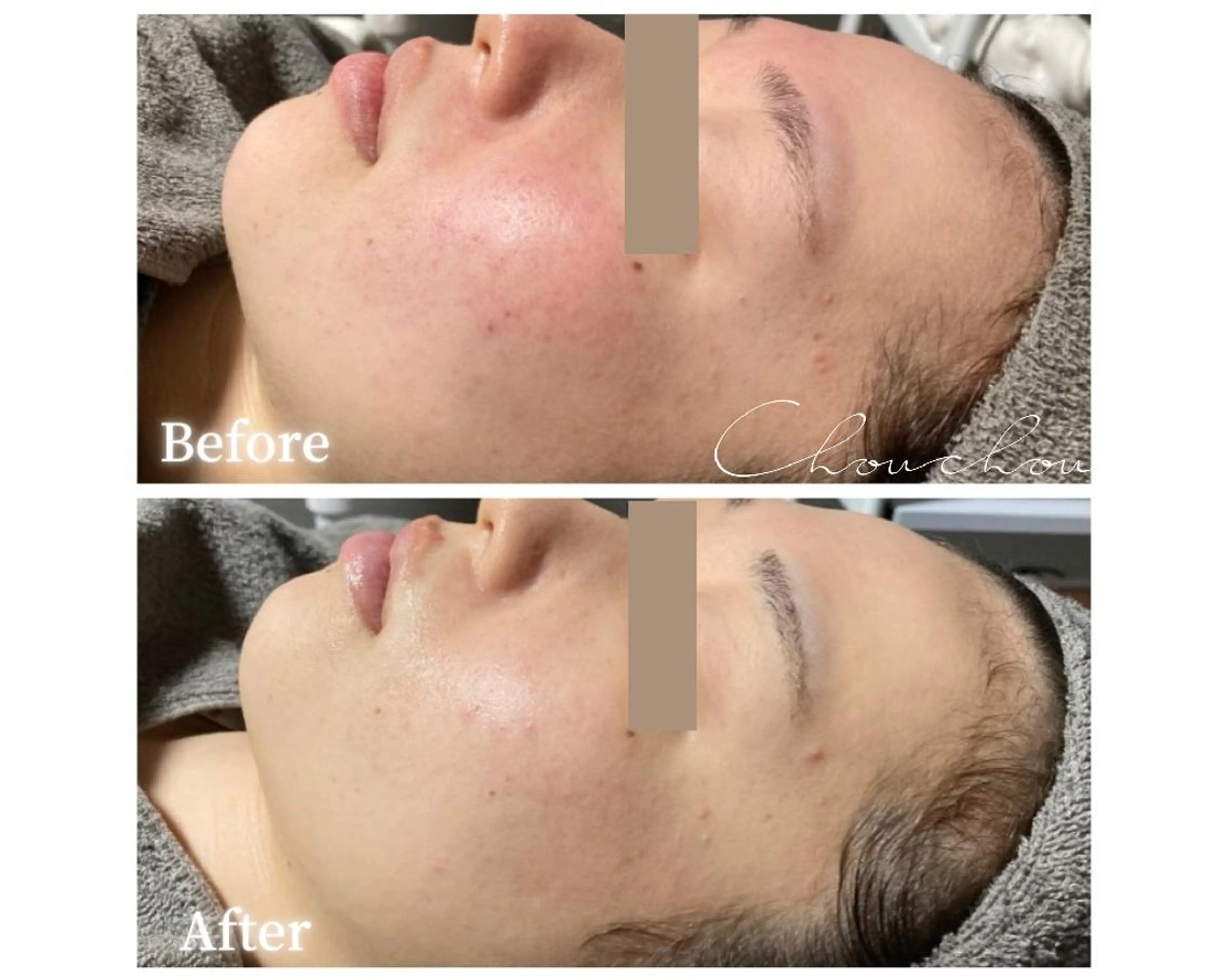 エステ beauty & health salon Chou chou所属・ニキビ・毛穴🌿肌を 育てるララピール✨のエステ・リラクイメージ