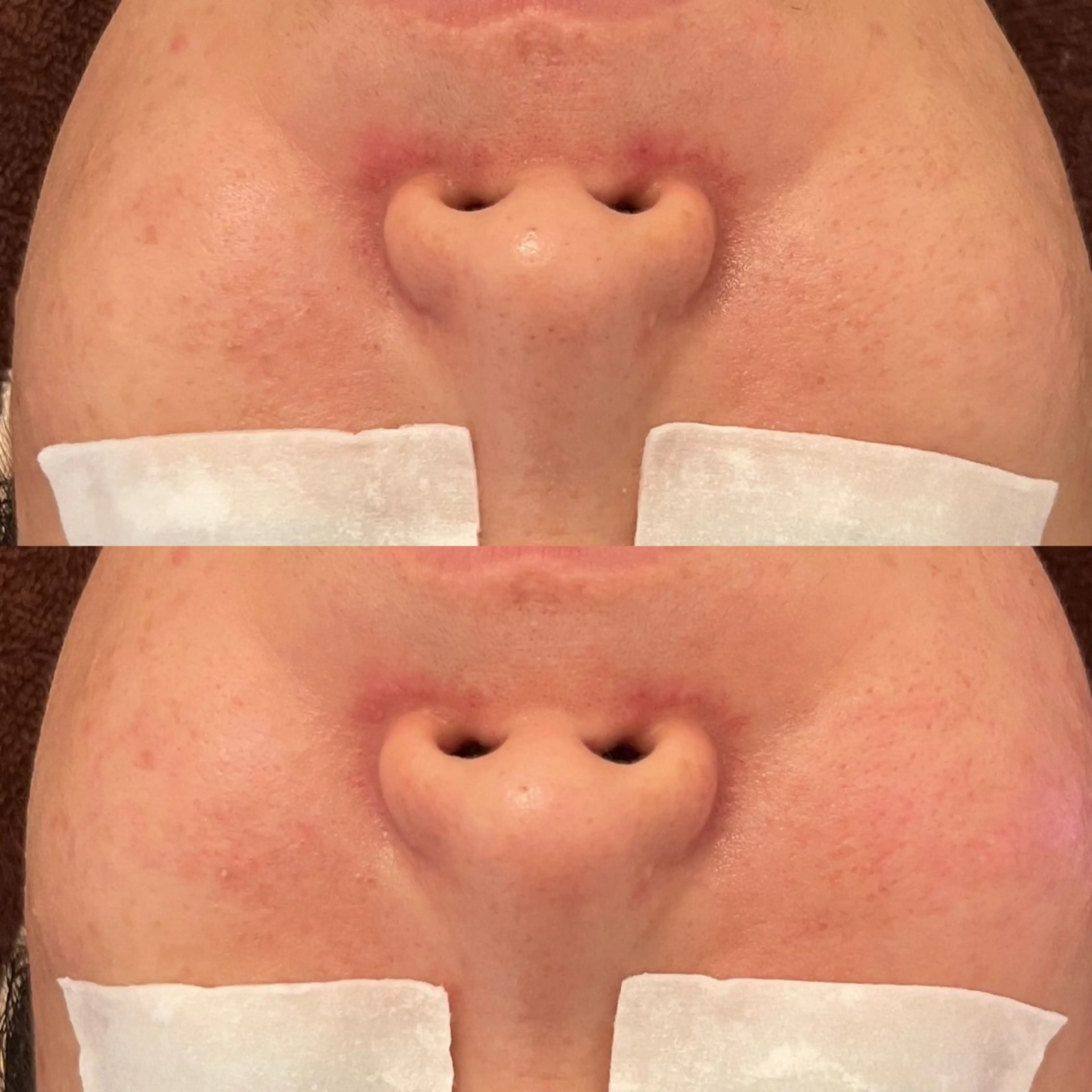 毛穴ケア/毛穴診断/ 毛穴洗浄〔心斎橋〕のエステ・リラクイメージ