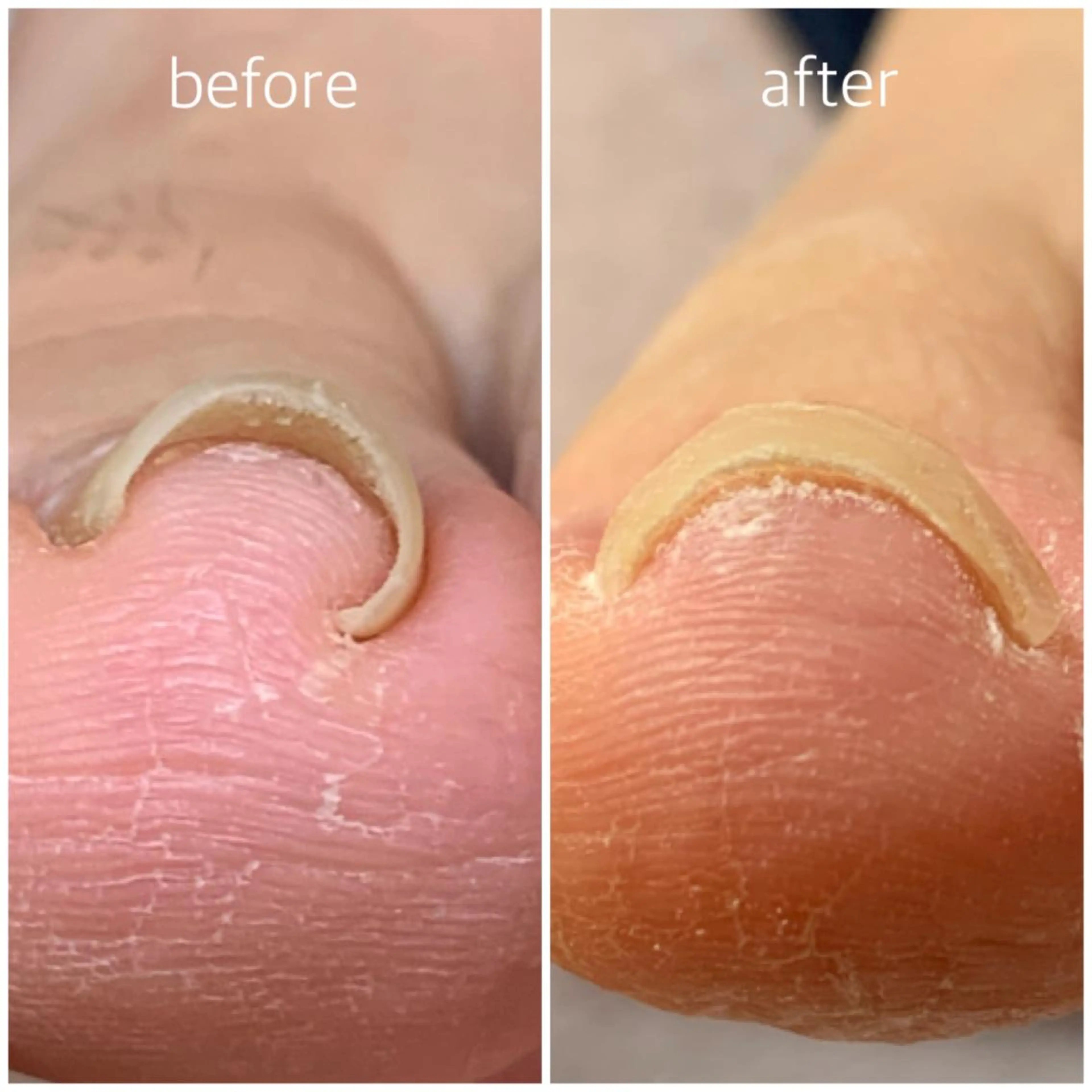 ♢特許取得済ペディグラス♢巻爪補正 痛みからの解放👼の写真