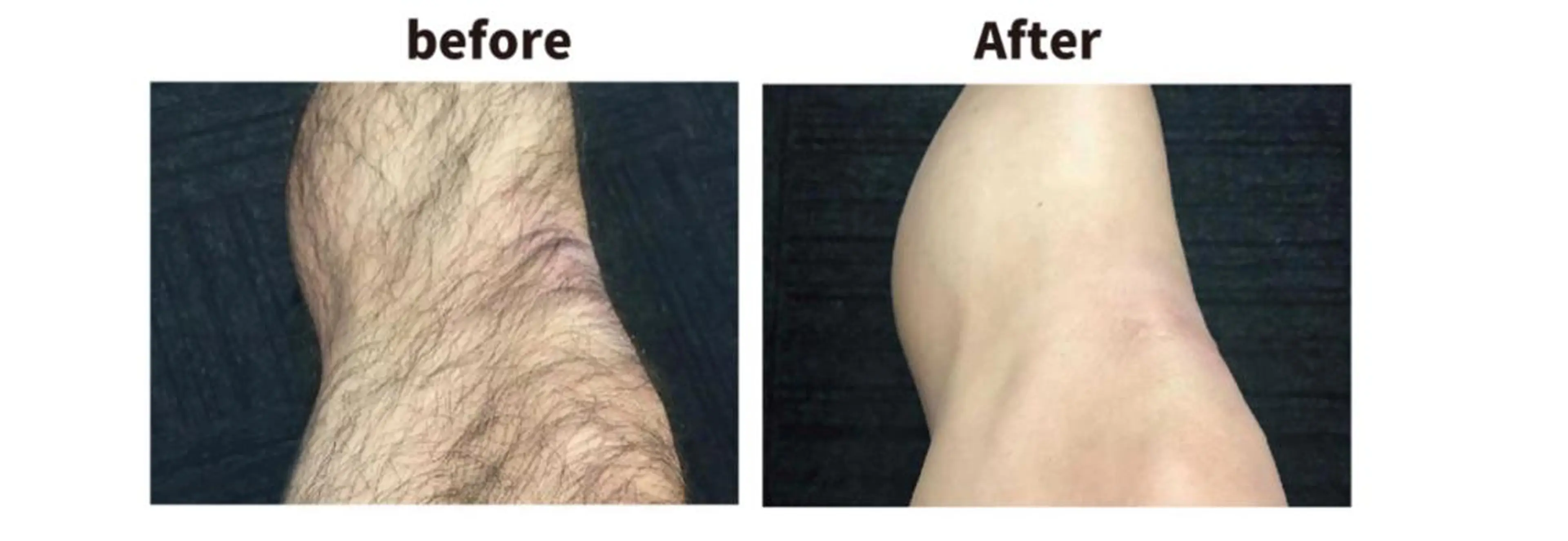 【メンズ脱毛】【ひざ下】痛みなく卒業も早い脱毛★仕上がりのお肌にご満足いただけます★の写真