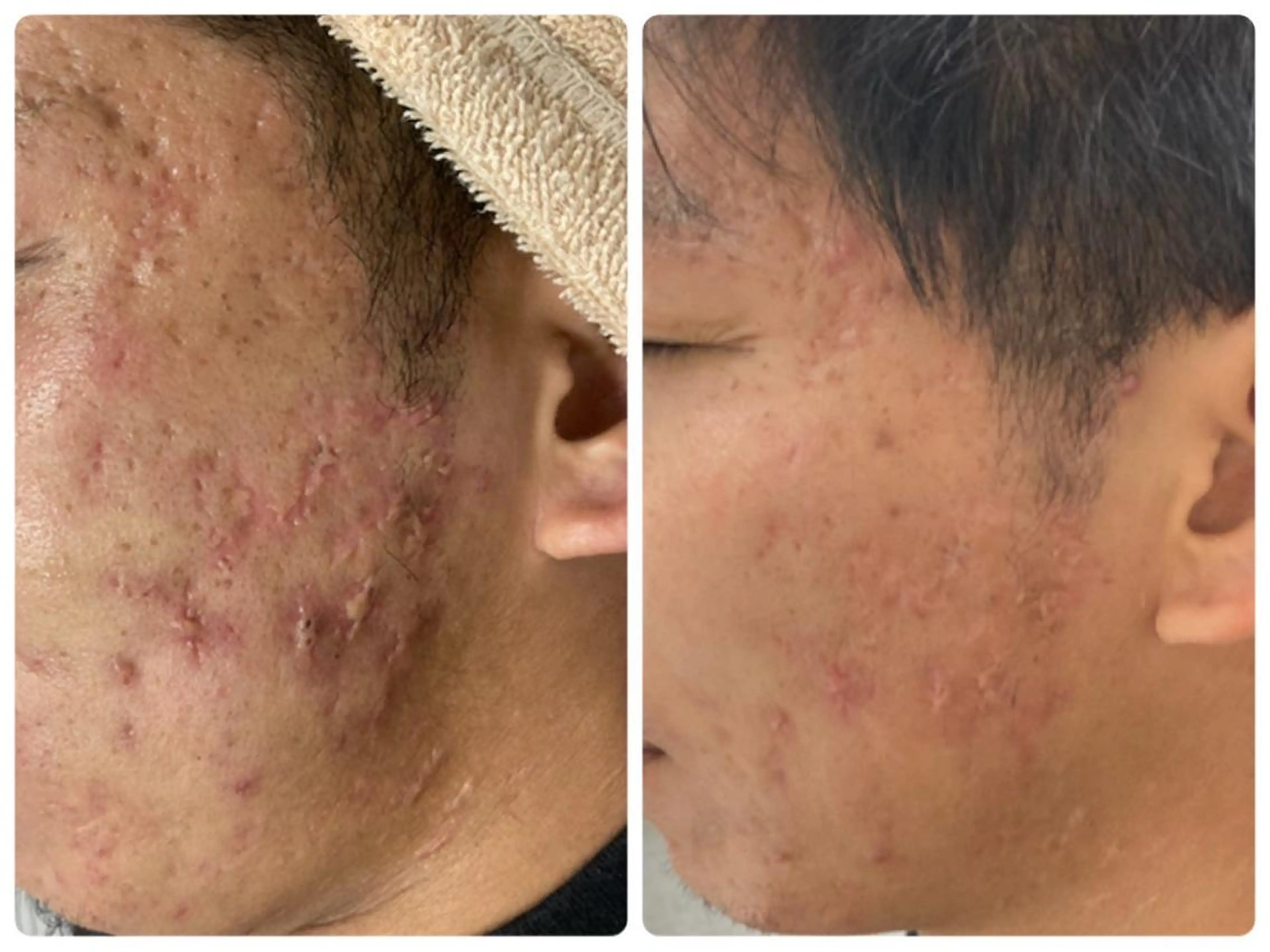 💁‍♂️男性の為の🌿ハーブピーリング🌿【HAAB REPROハーブリプロ】の写真