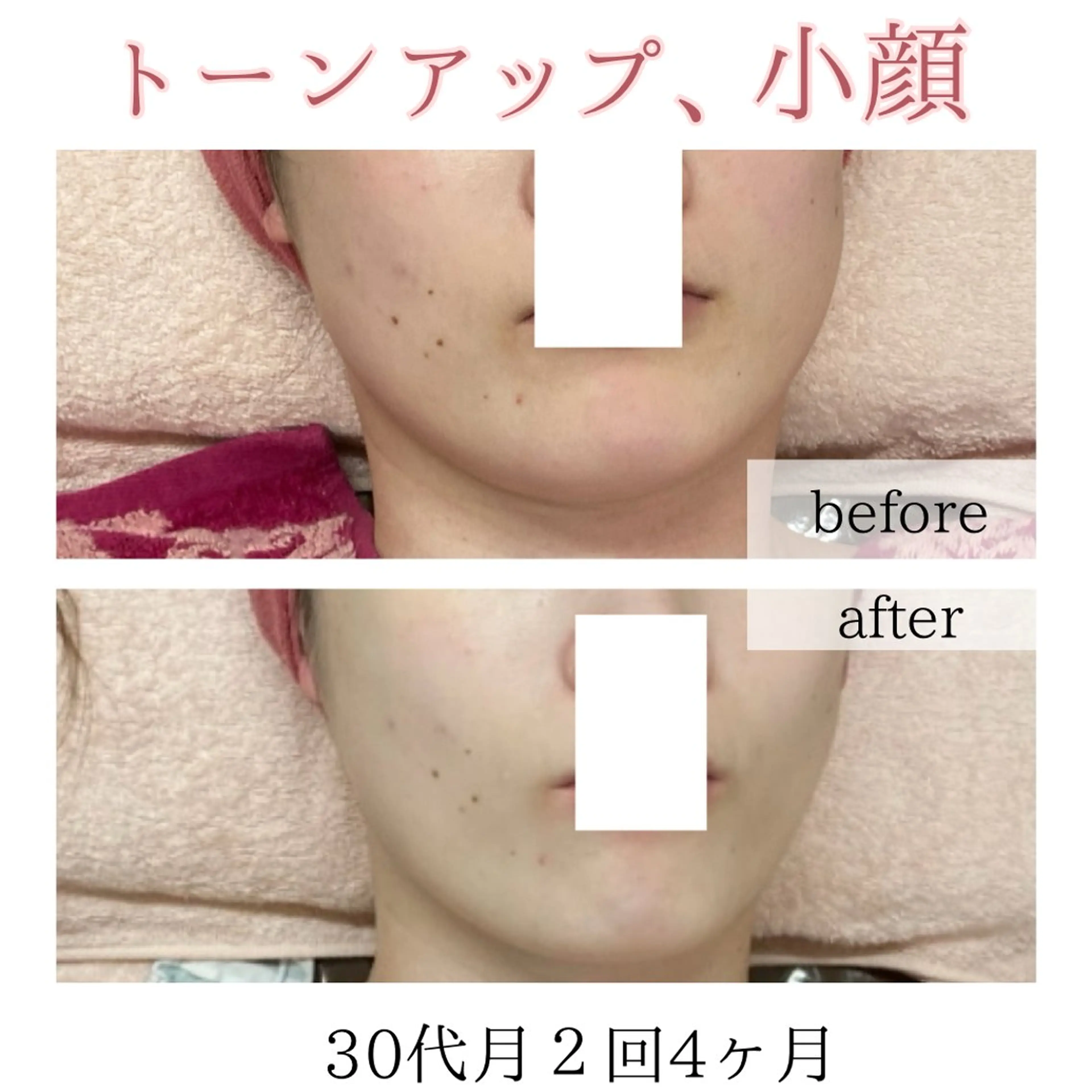 オアシス・さくら所属・小顔（シミ ニキビ）脱毛サロンのエステ・リラクイメージ