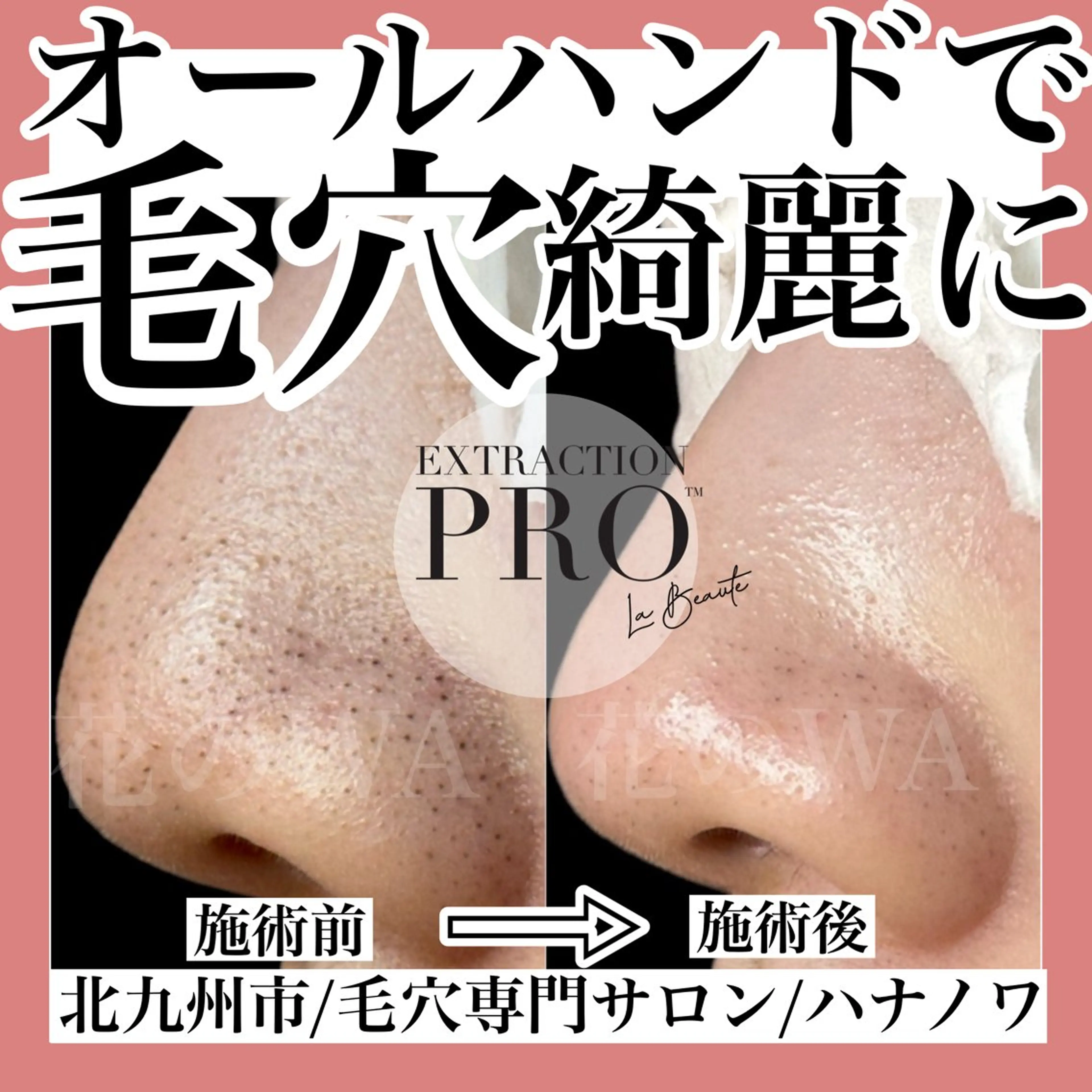 ★人気NO1★【頑固な毛穴のつまりには毛穴エクストラクションプロ3回券】の写真