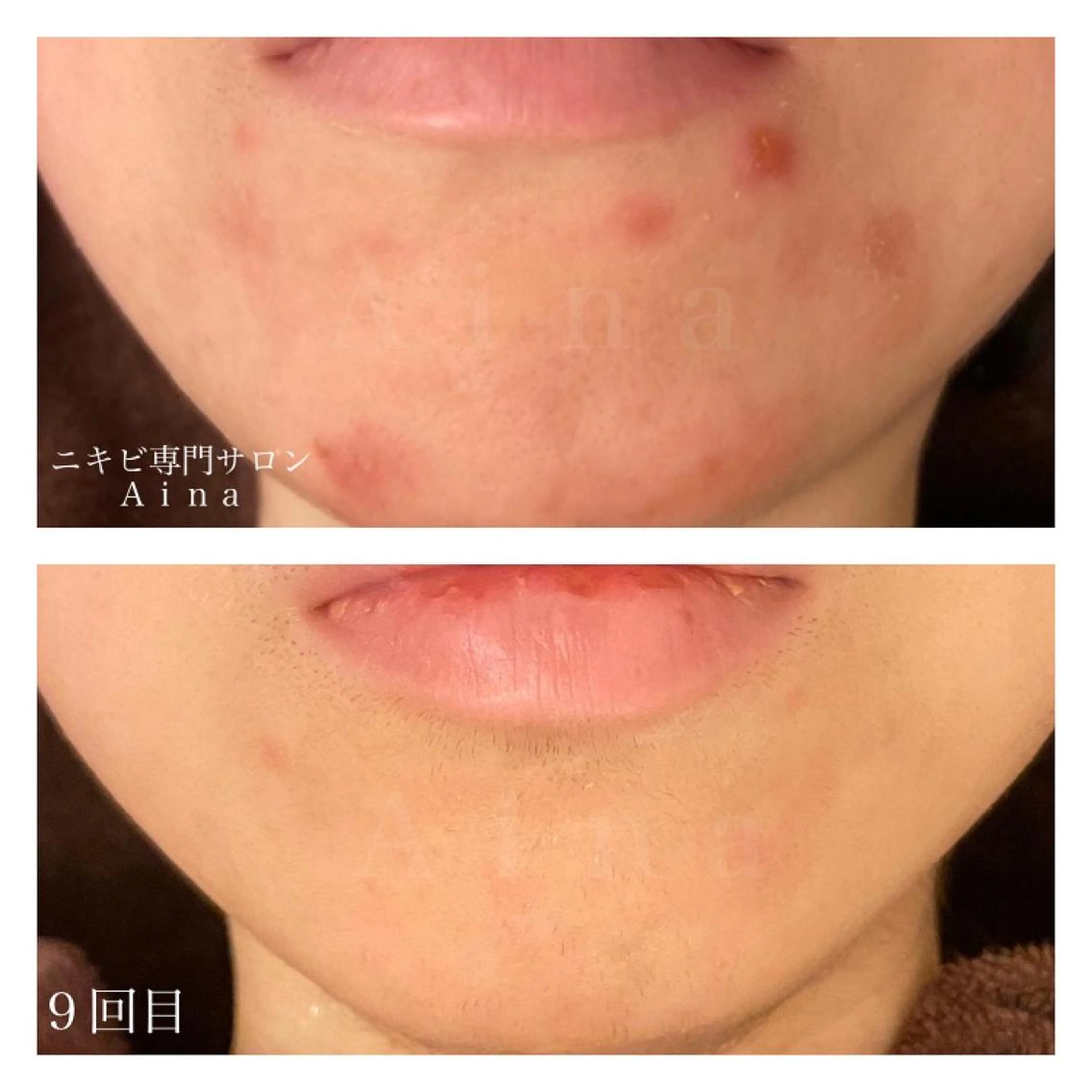 ミディアム カラー パーマ ヘアアレンジ メンズ キッズ ネイル マツエク・マツパ 学生（メンズ向け） 学生 エステ リラク ニキビ跡専門サロン Ａｉｎａのエステ・リラクイメージ