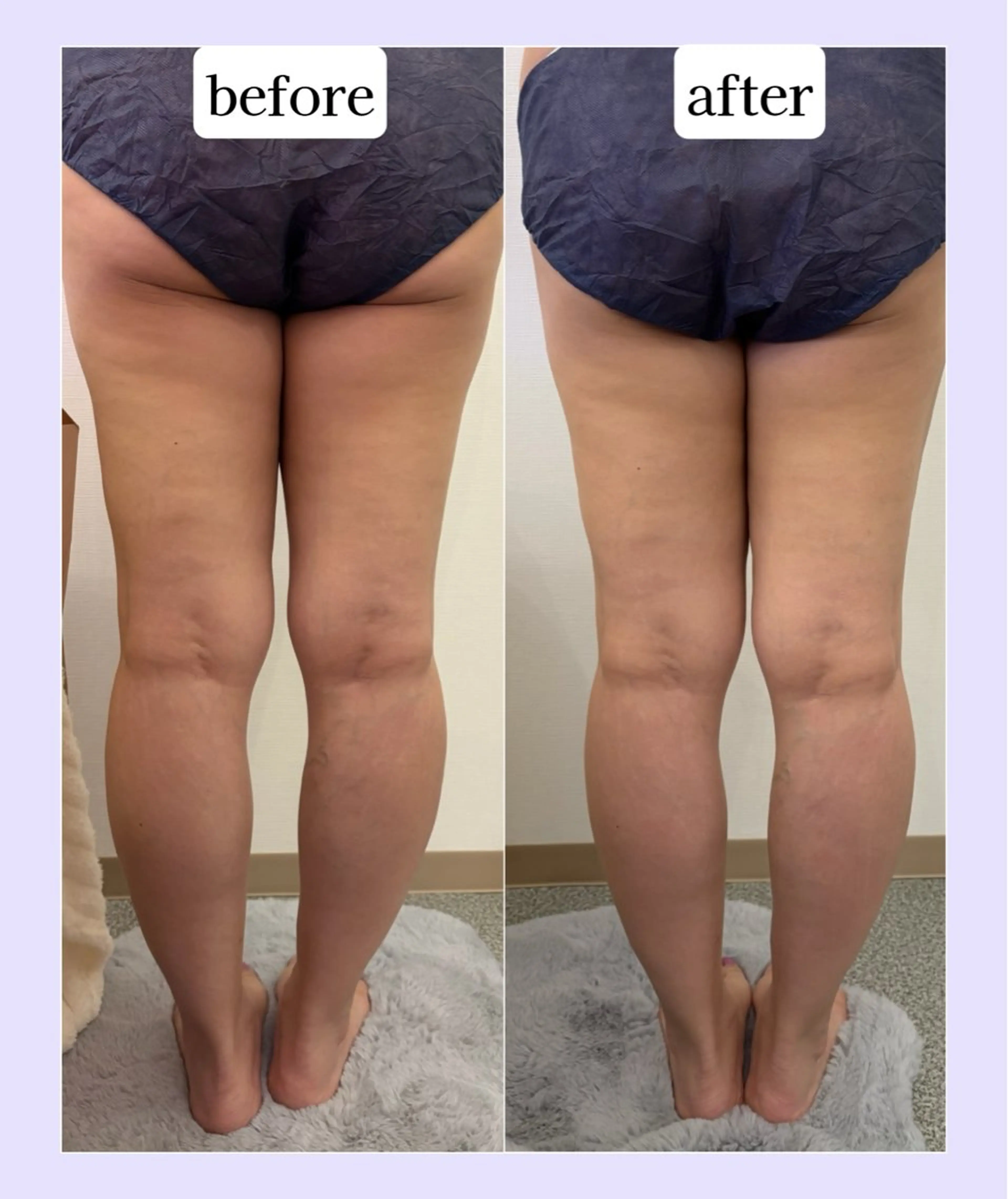 【期間限定モニター】💎ラジオ波×キャビテーション痩身💎（60分）の写真