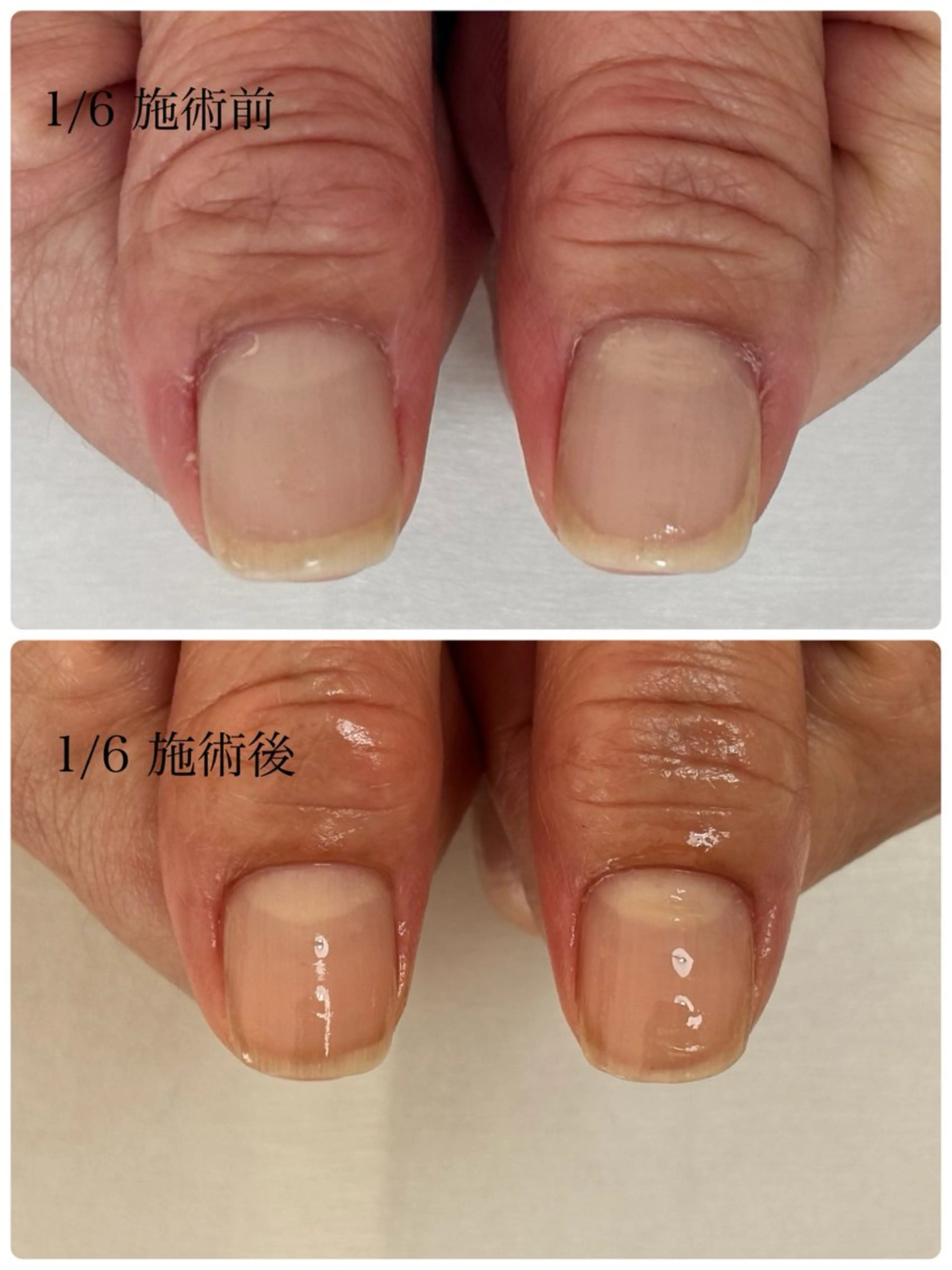 ネイル ラメ(グリッター) ハンドネイル Alo.nail アロ•ネイルのネイルデザイン